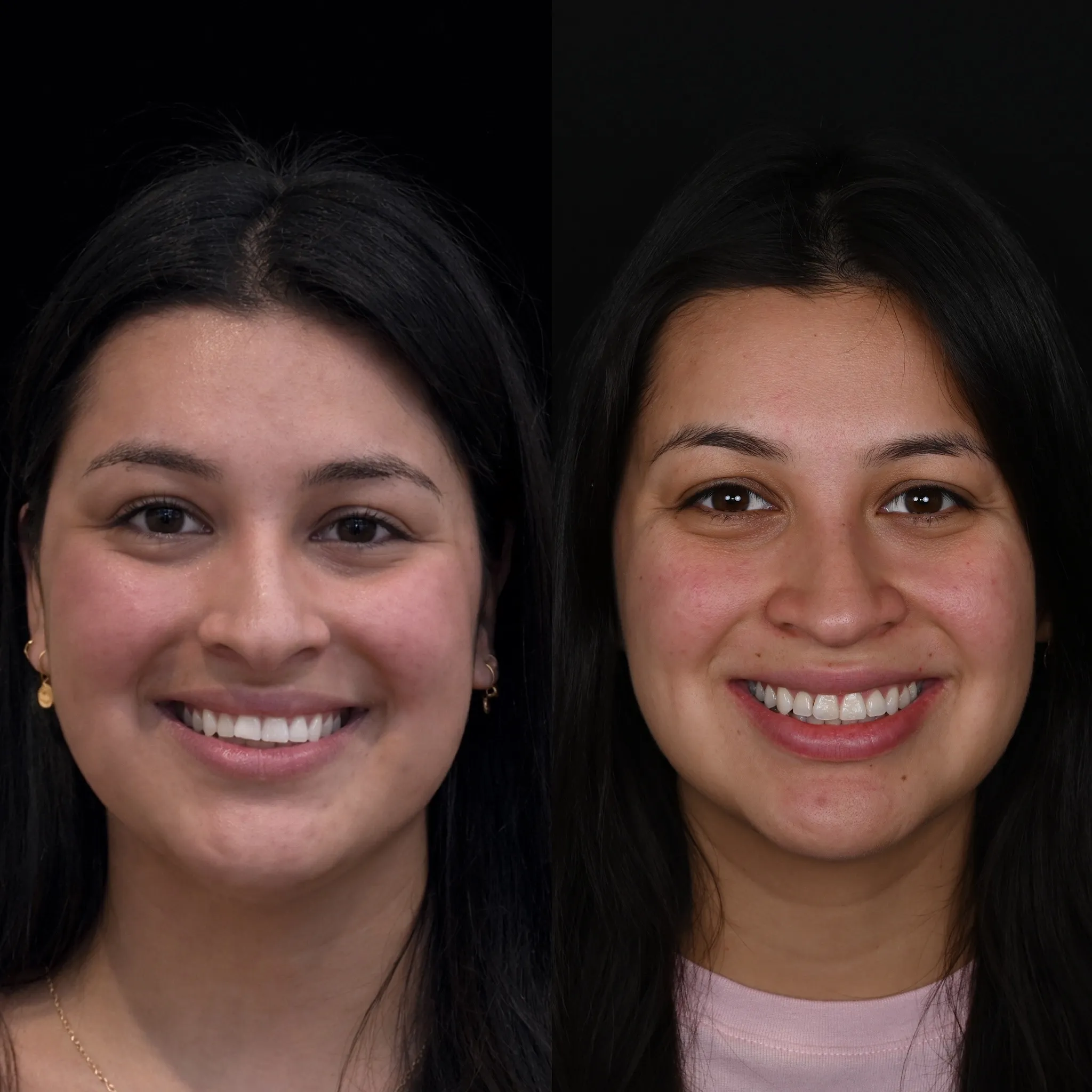 Discreet clear aligners treatment at Legacy Dental Pasadena helping patients achieve a straighter, healthier smile