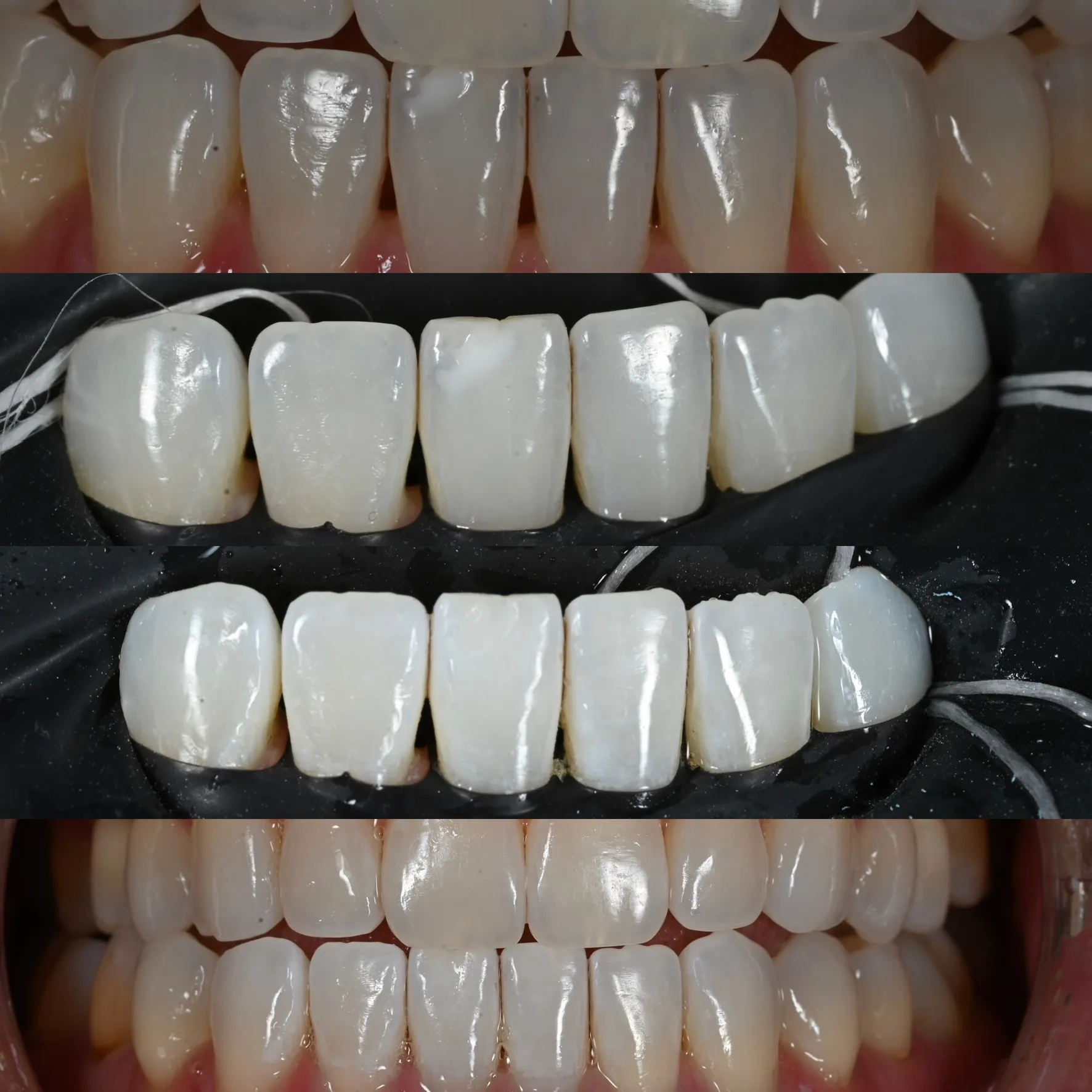 Collage showing close-ups of human front teeth before and after ICON Resin Infiltration at Legacy Dental Pasadena