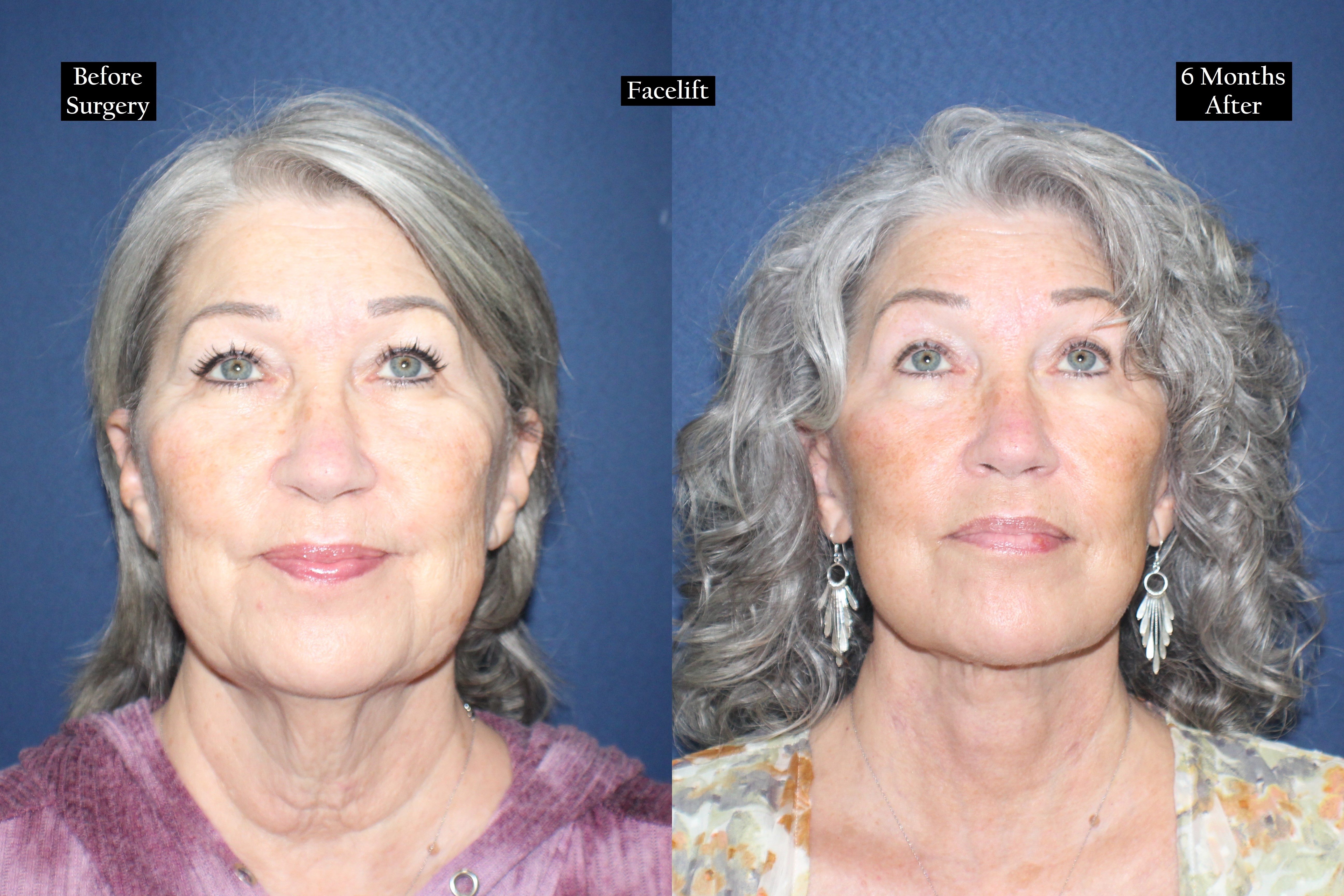 Before and after shot of woman looking up 