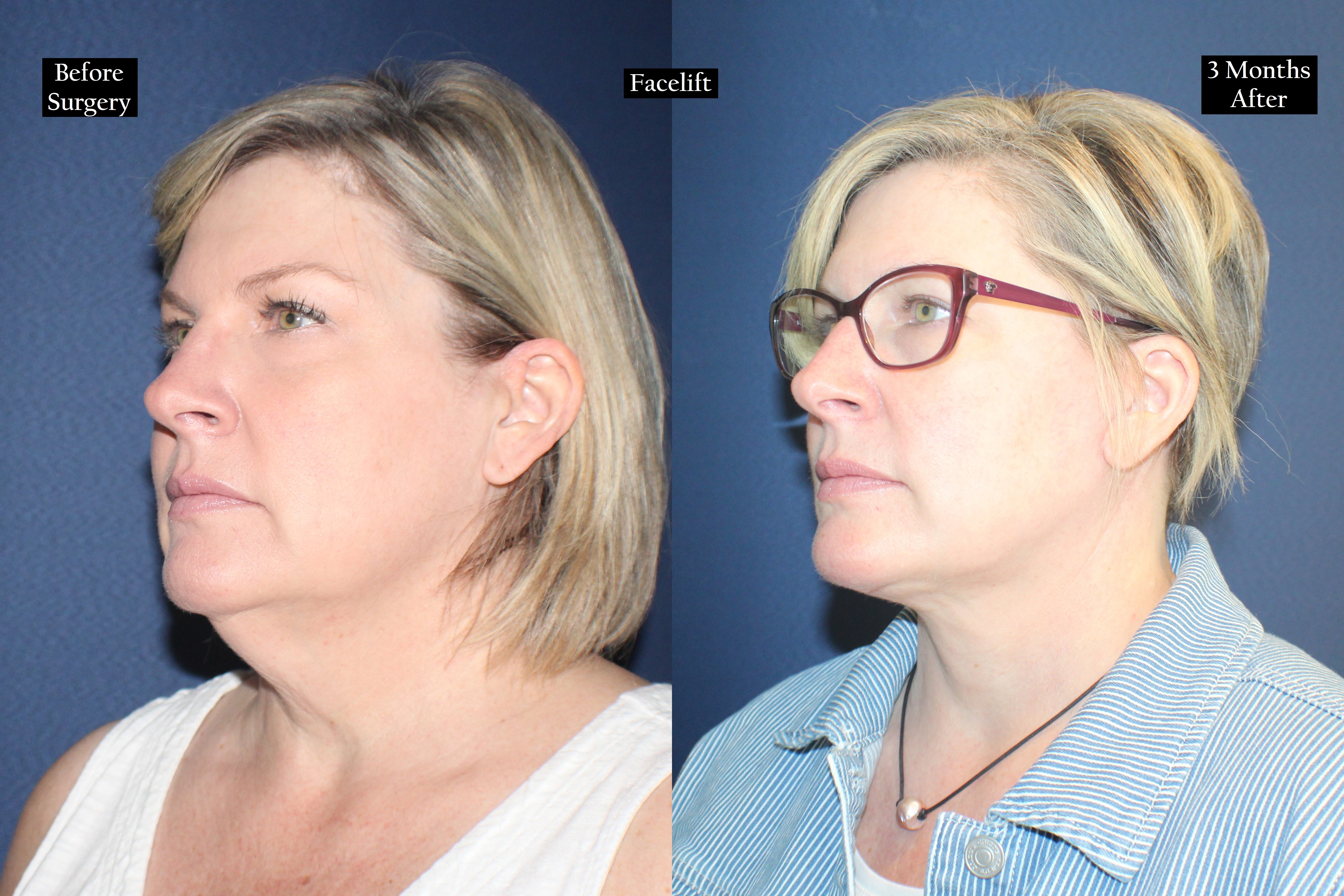 Before and after shot of woman's face wearing glasses