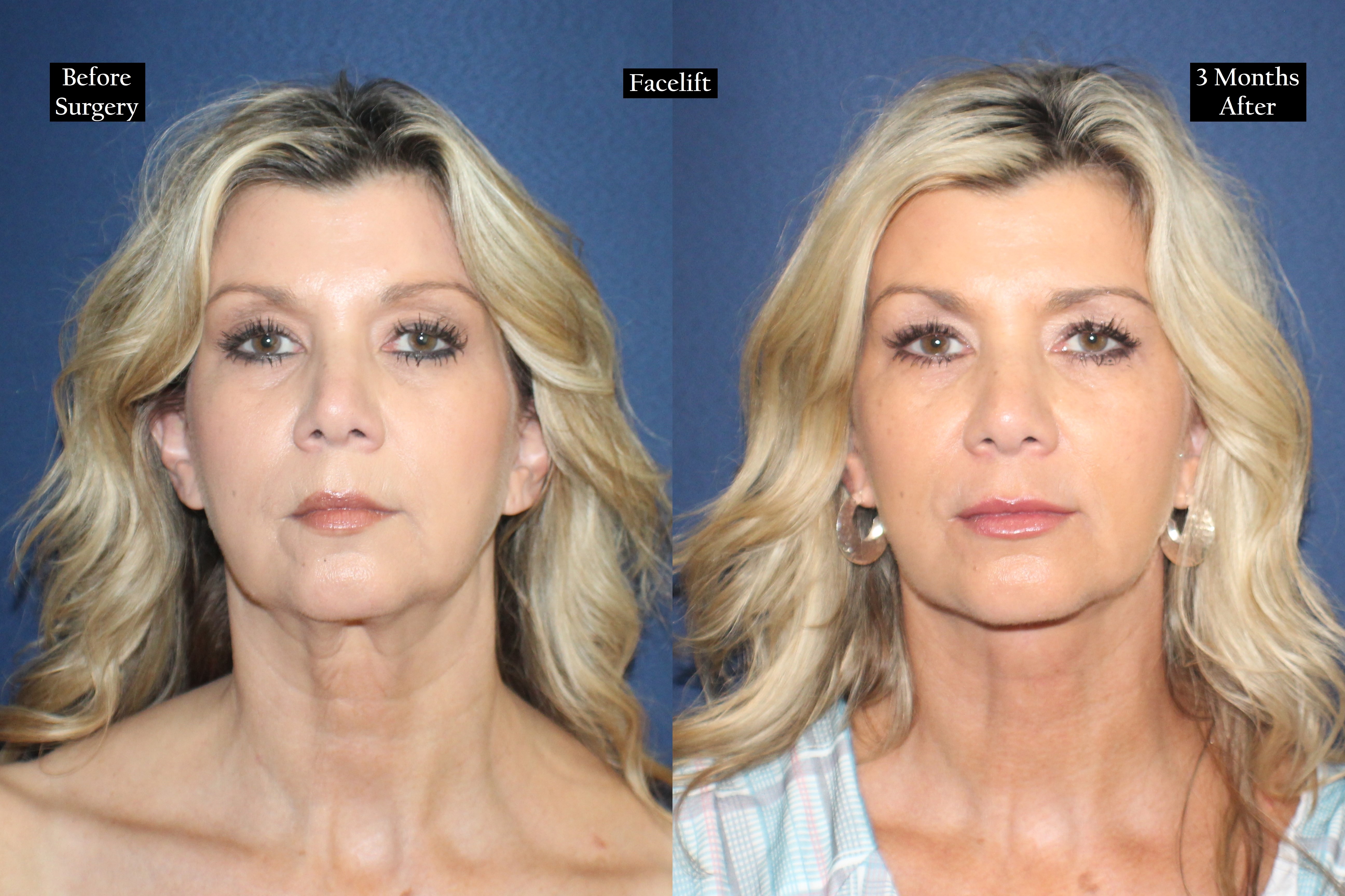 Before and after shot of woman's face on blue background