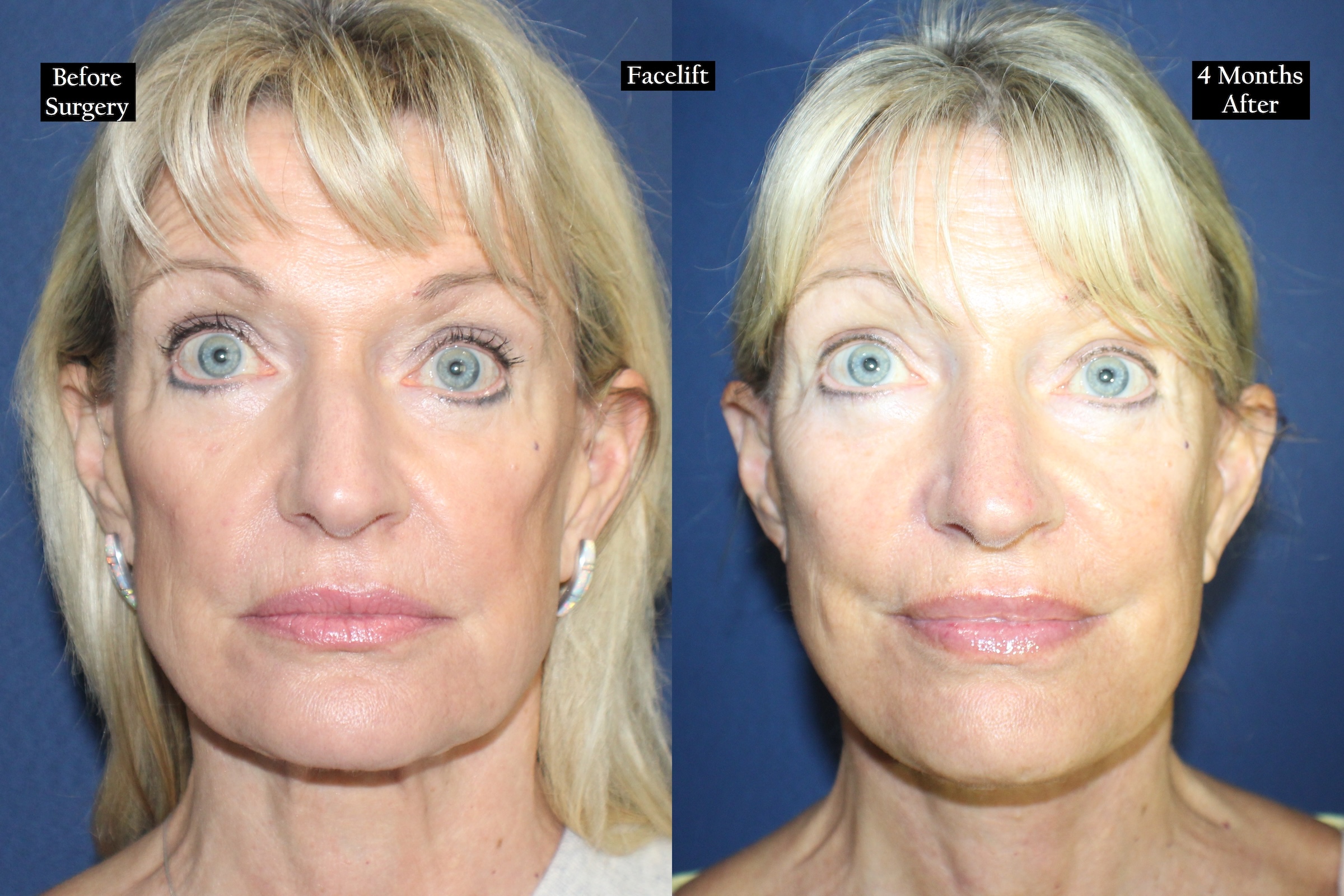 Before and after shot of woman's face