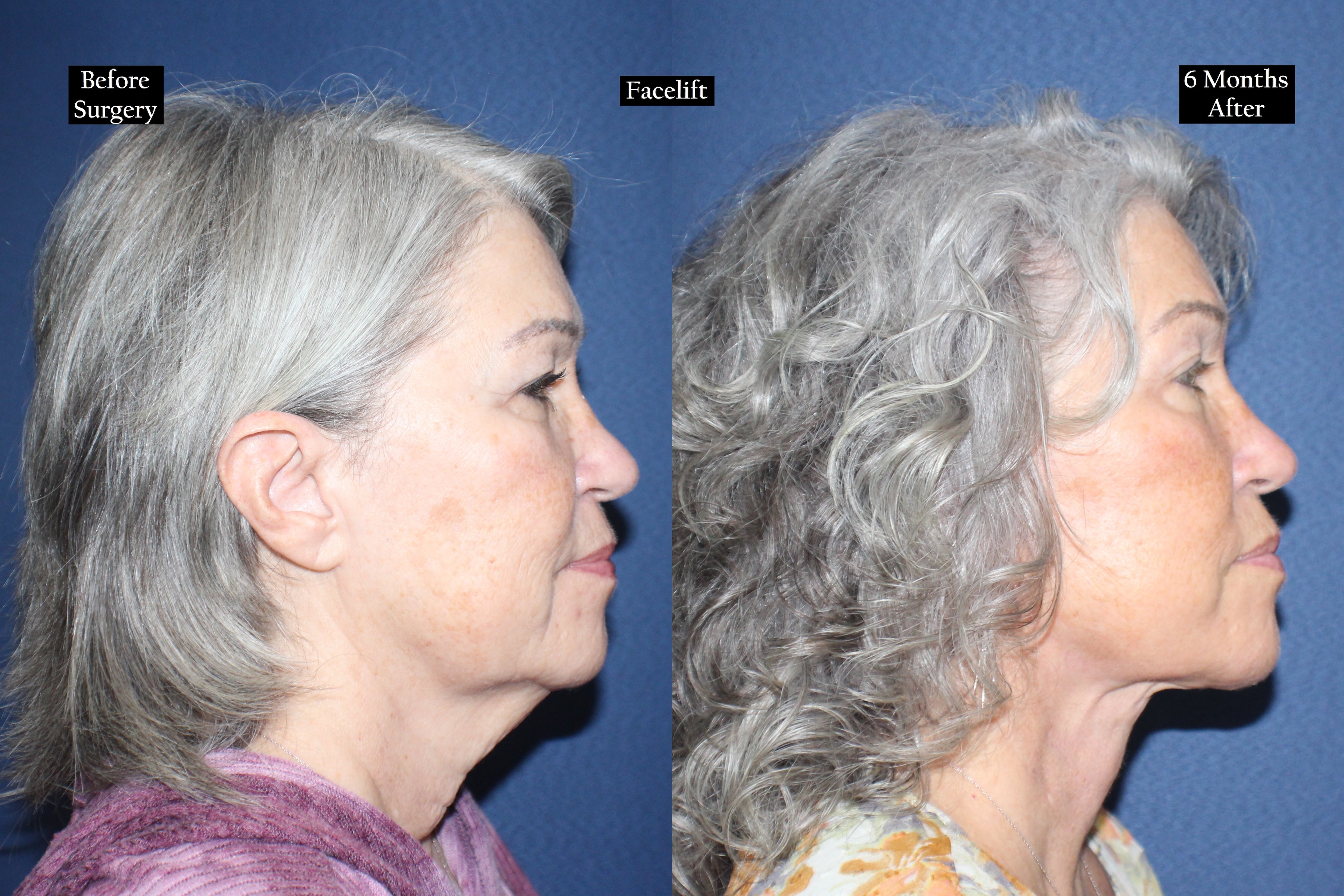 Before and after shot of woman looking to the right