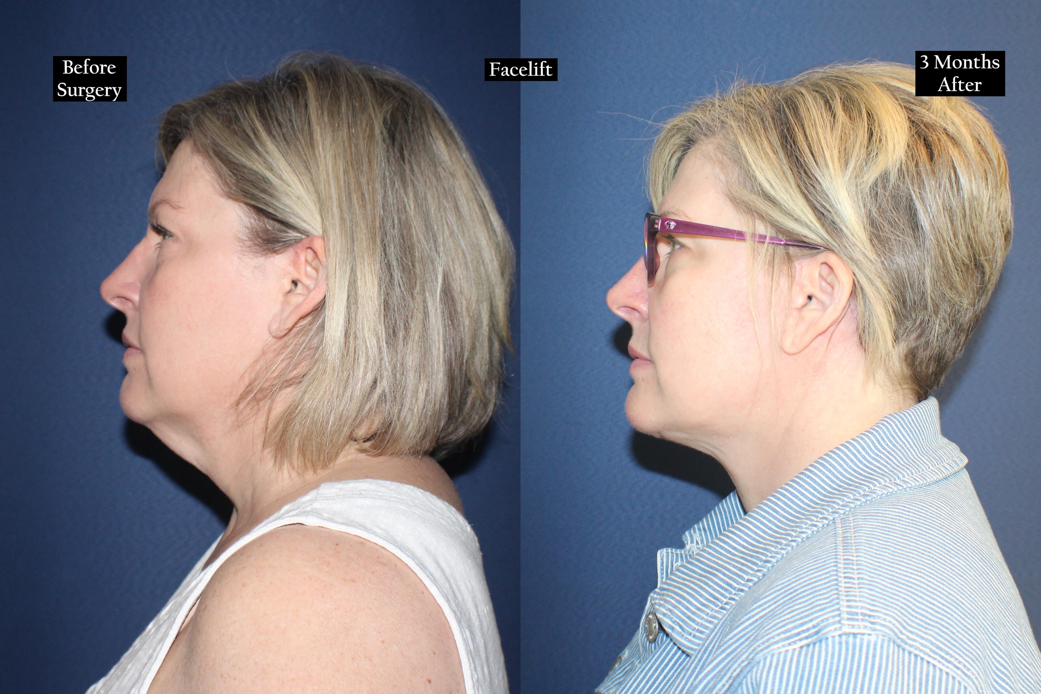 Before and after shot of woman's face wearing glasses in profile