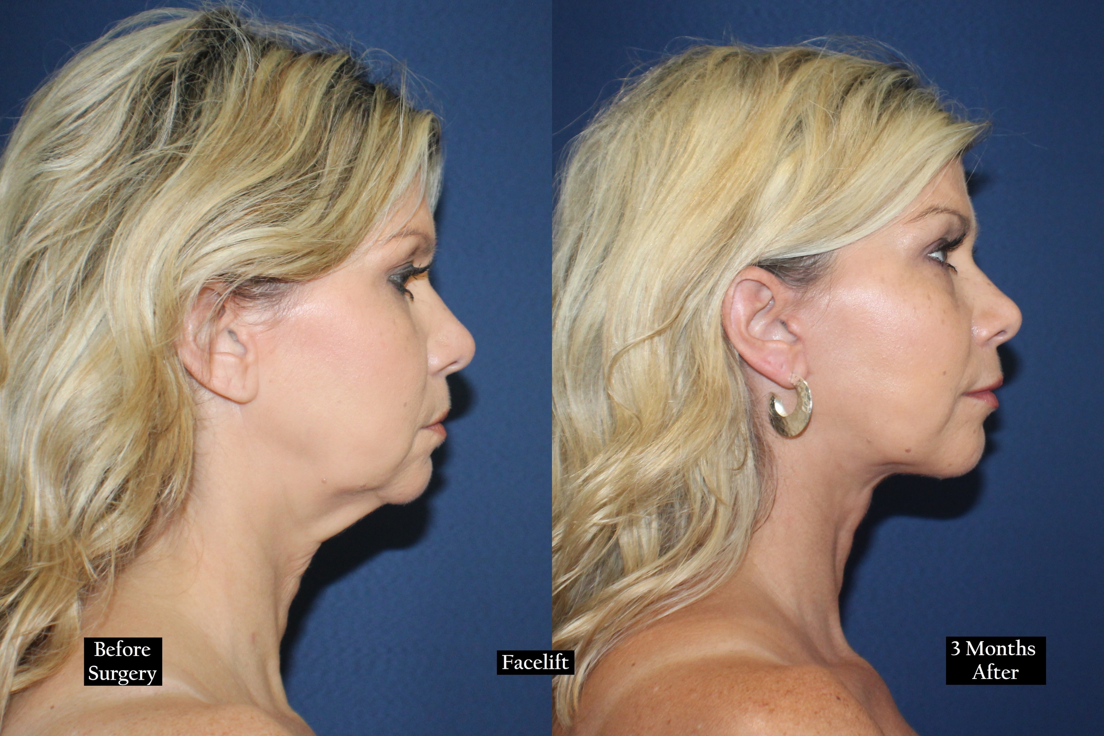 Before and after shot of woman's face in profile looking right