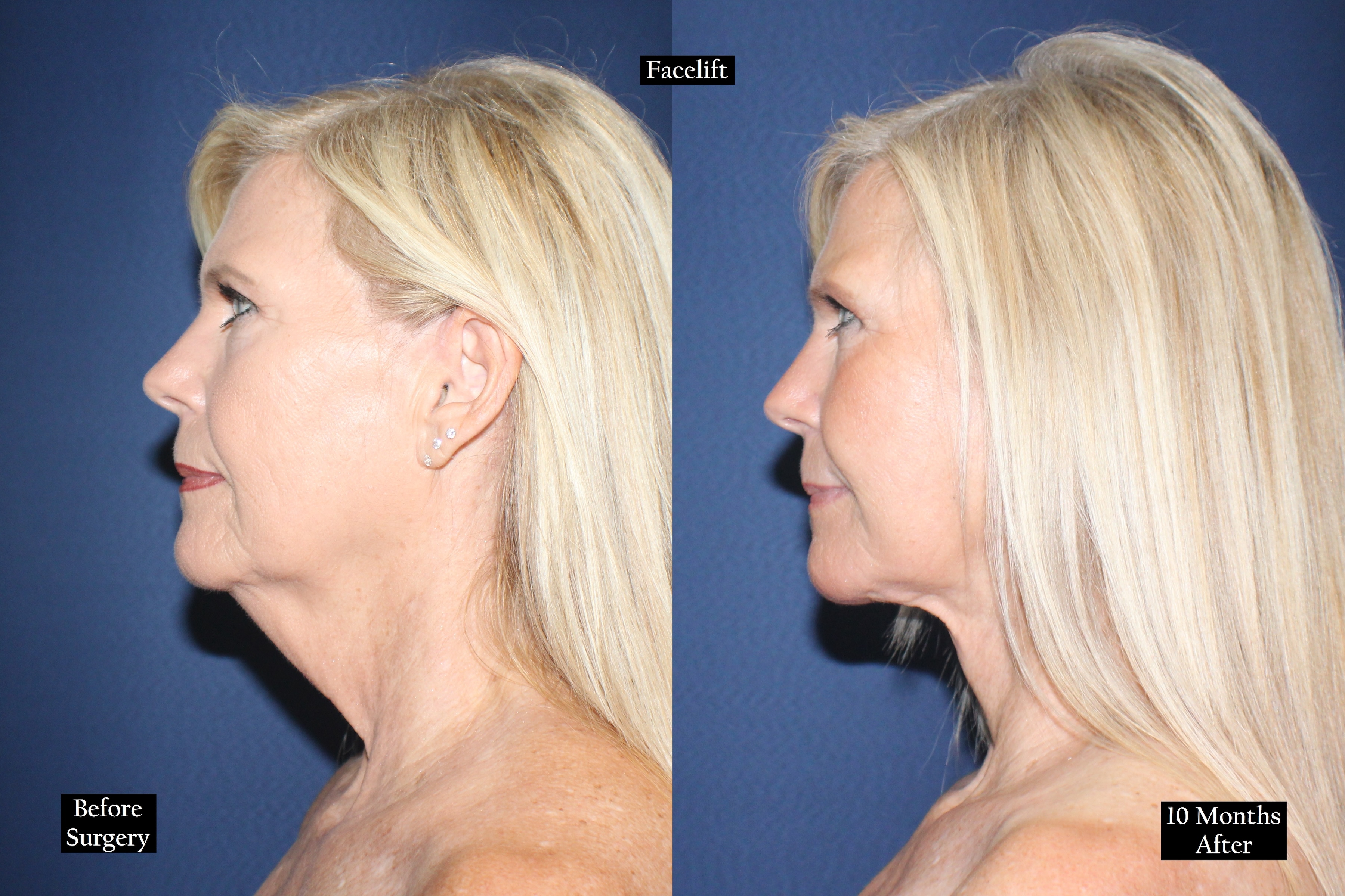 Before and after shot of woman's face in profile