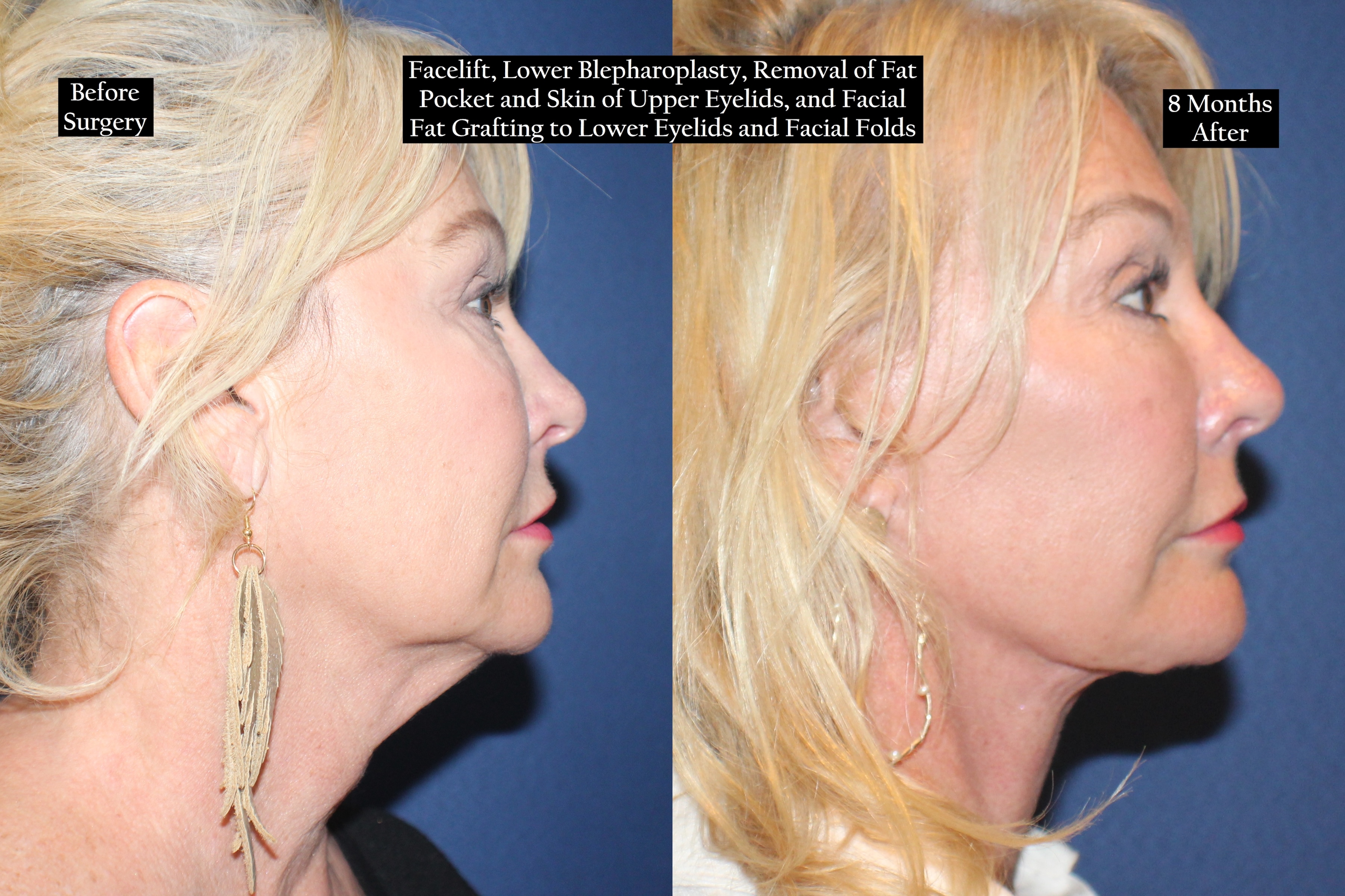 Before and after shot of a blonde woman from the right