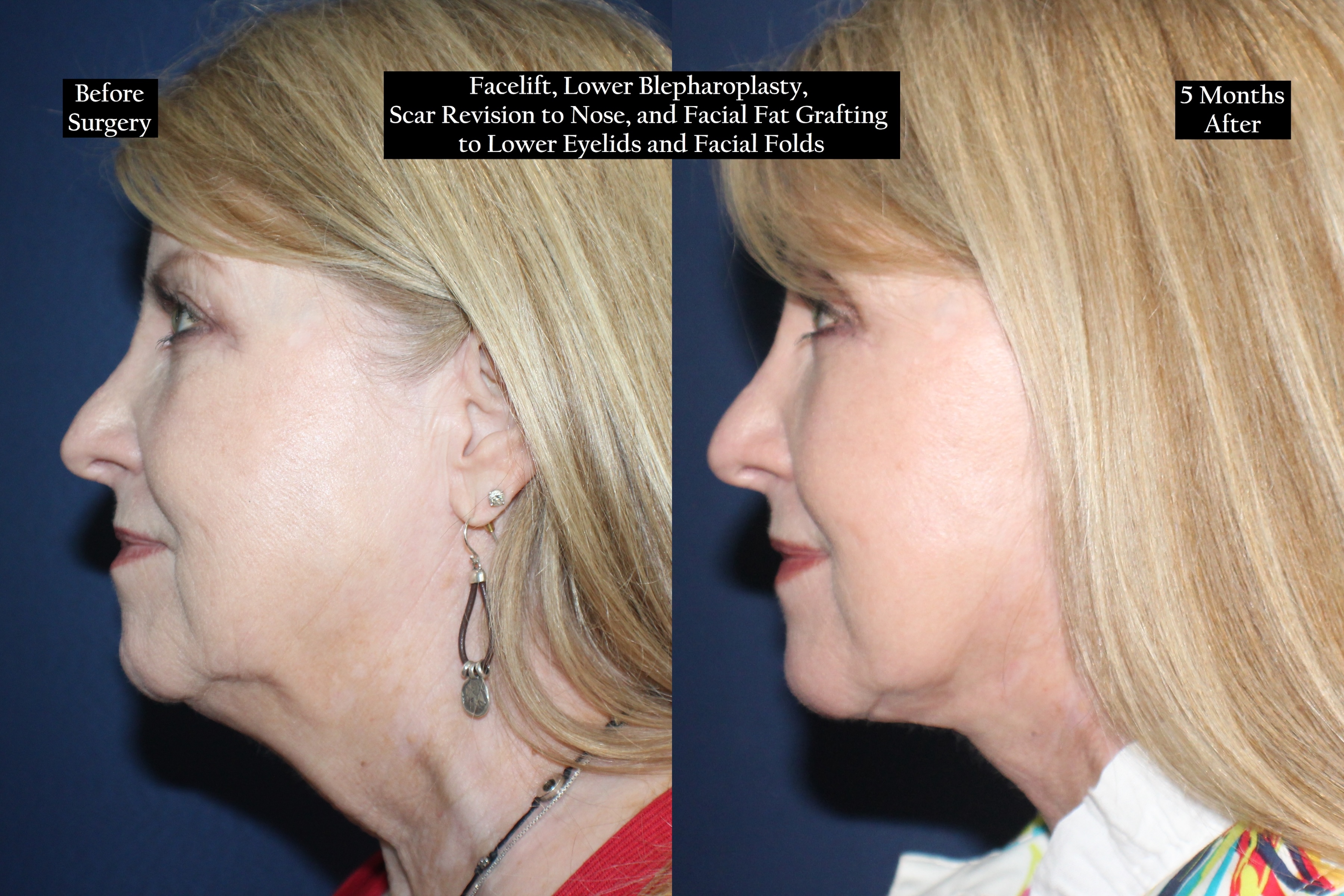 Before and after shot of another woman from right