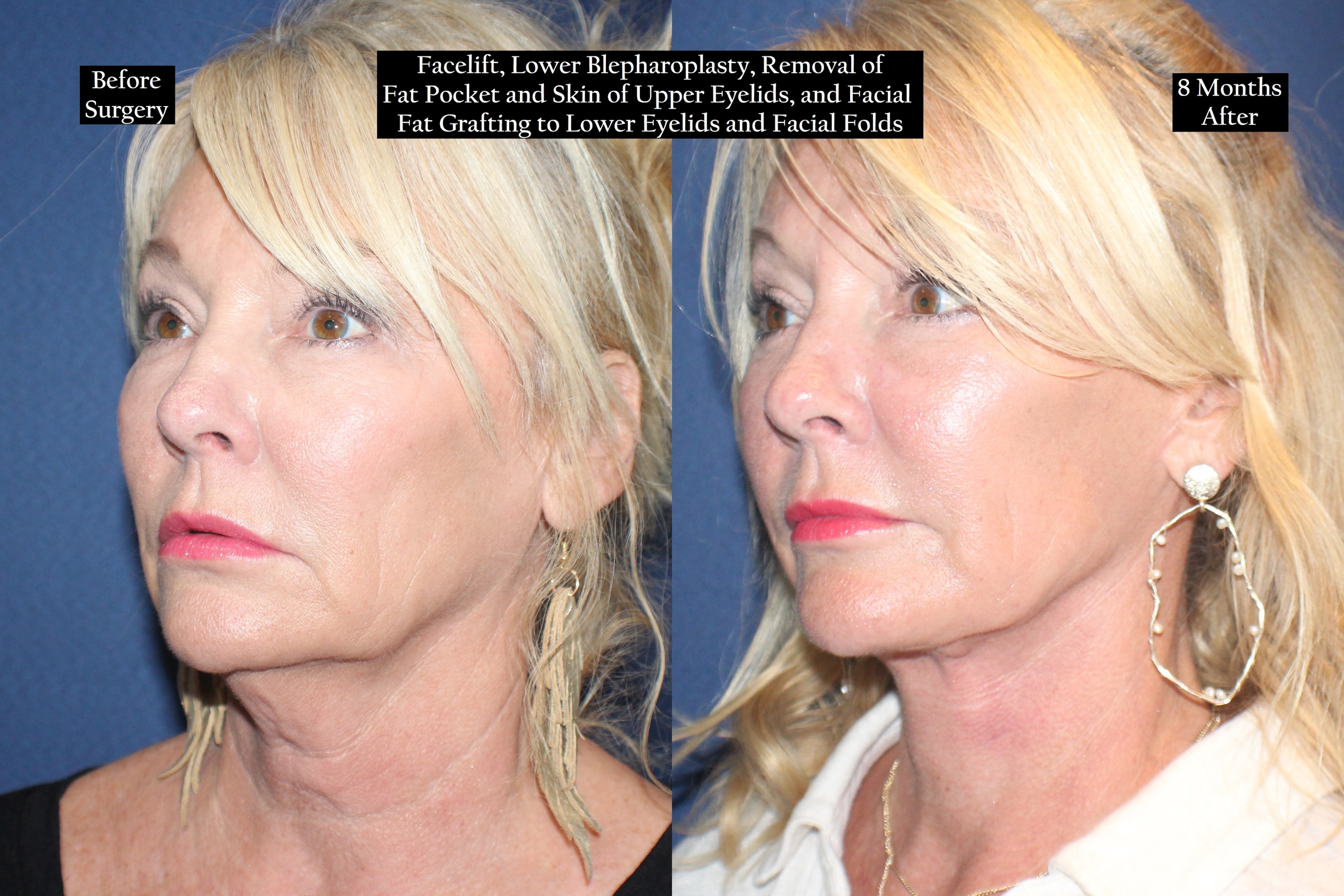 Before and after shot of a blonde woman from the left