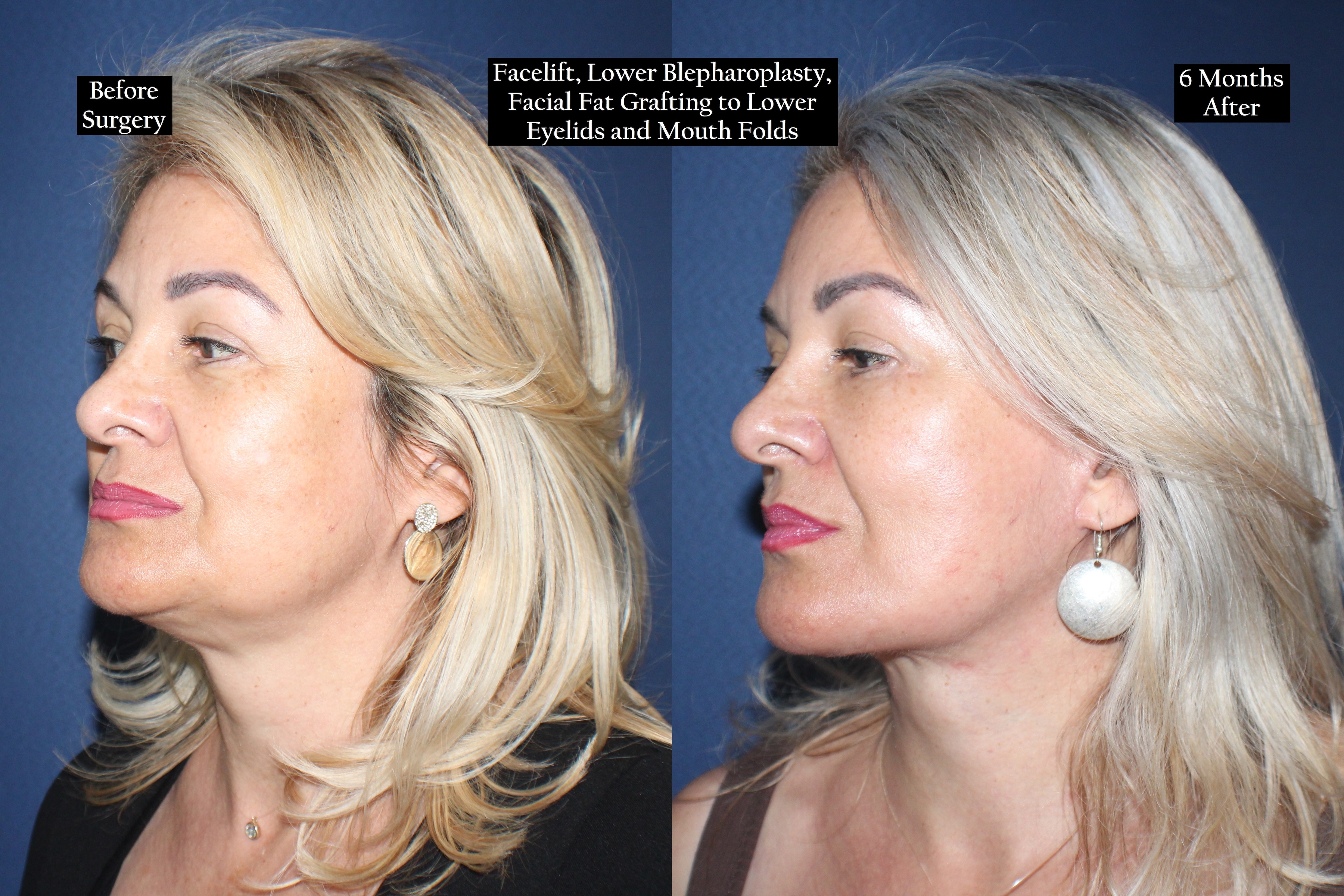 Before and after shot of woman from the left