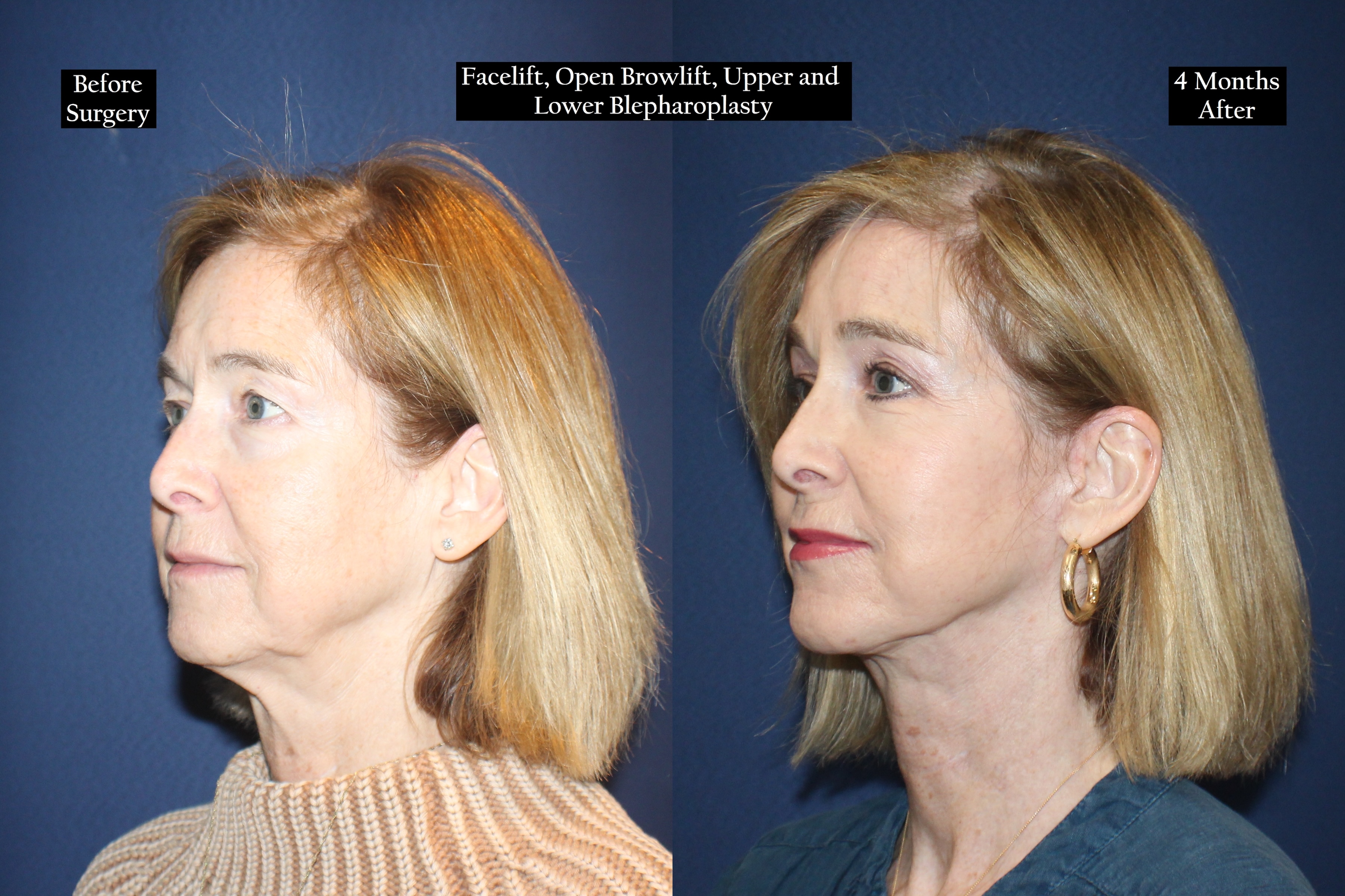 Before and after shot of woman with shoulder length hair from the left