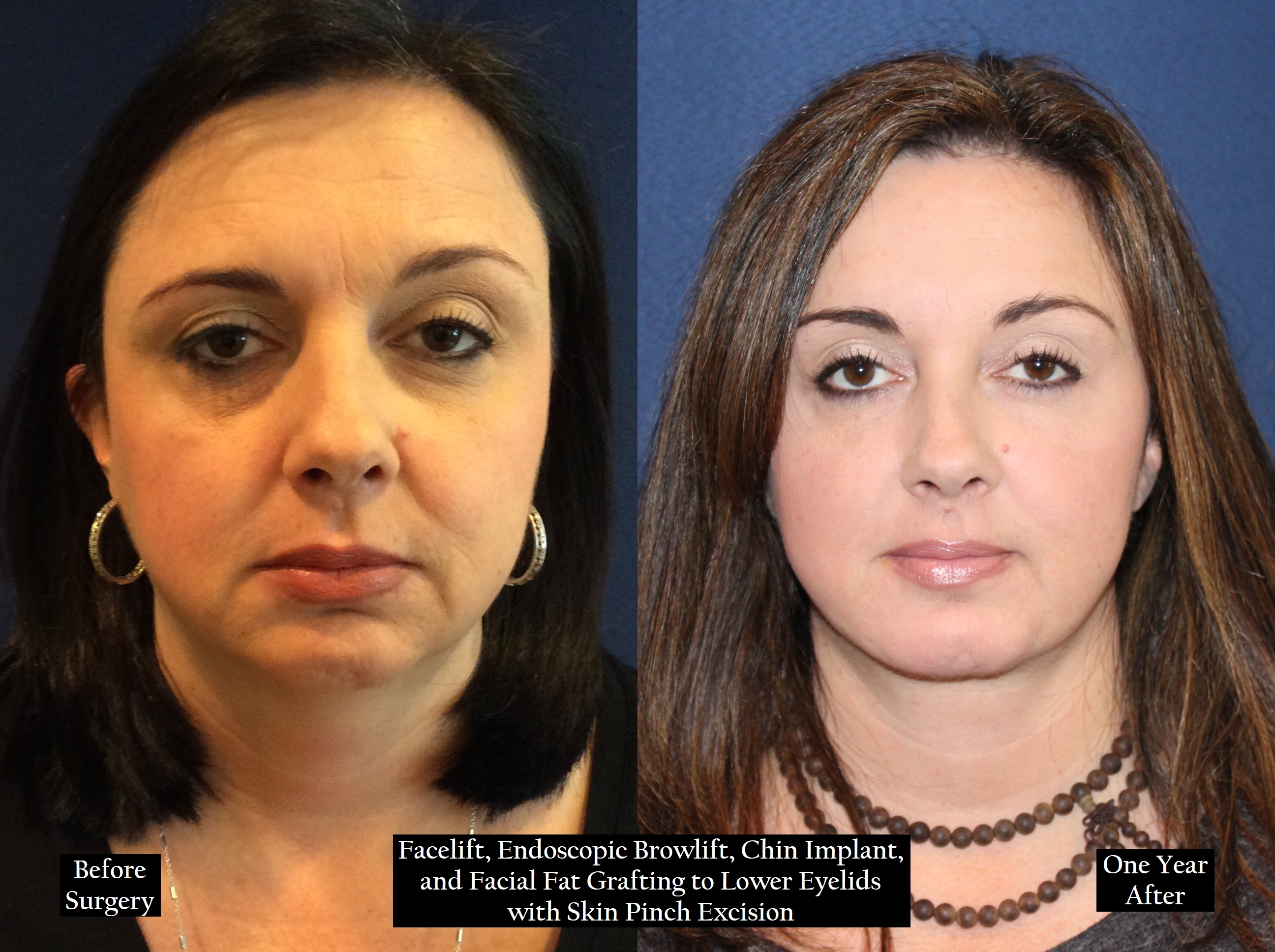 Before and after shot of a woman with brown hair head on