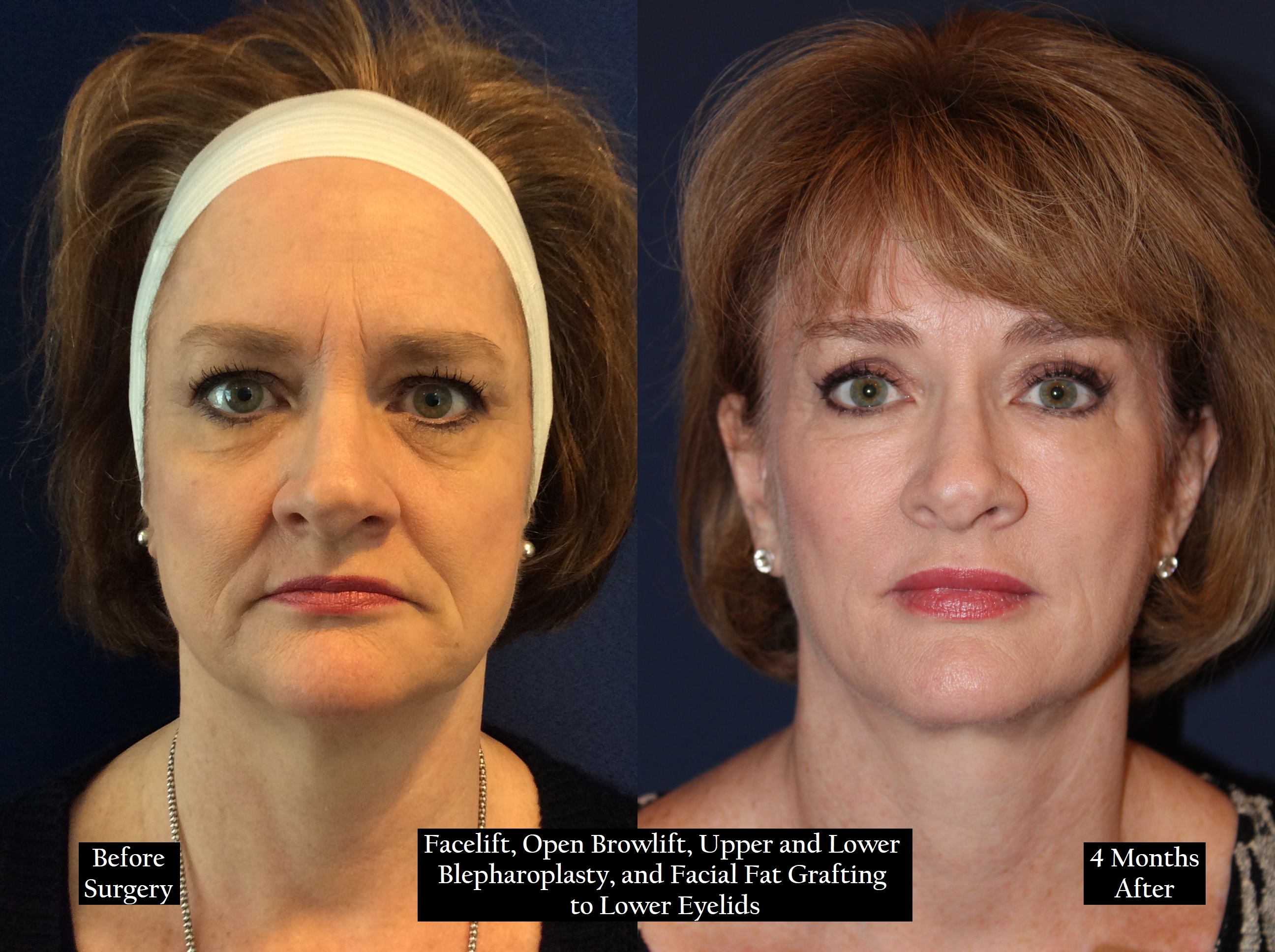 Before and after shot of a woman with red hair head on