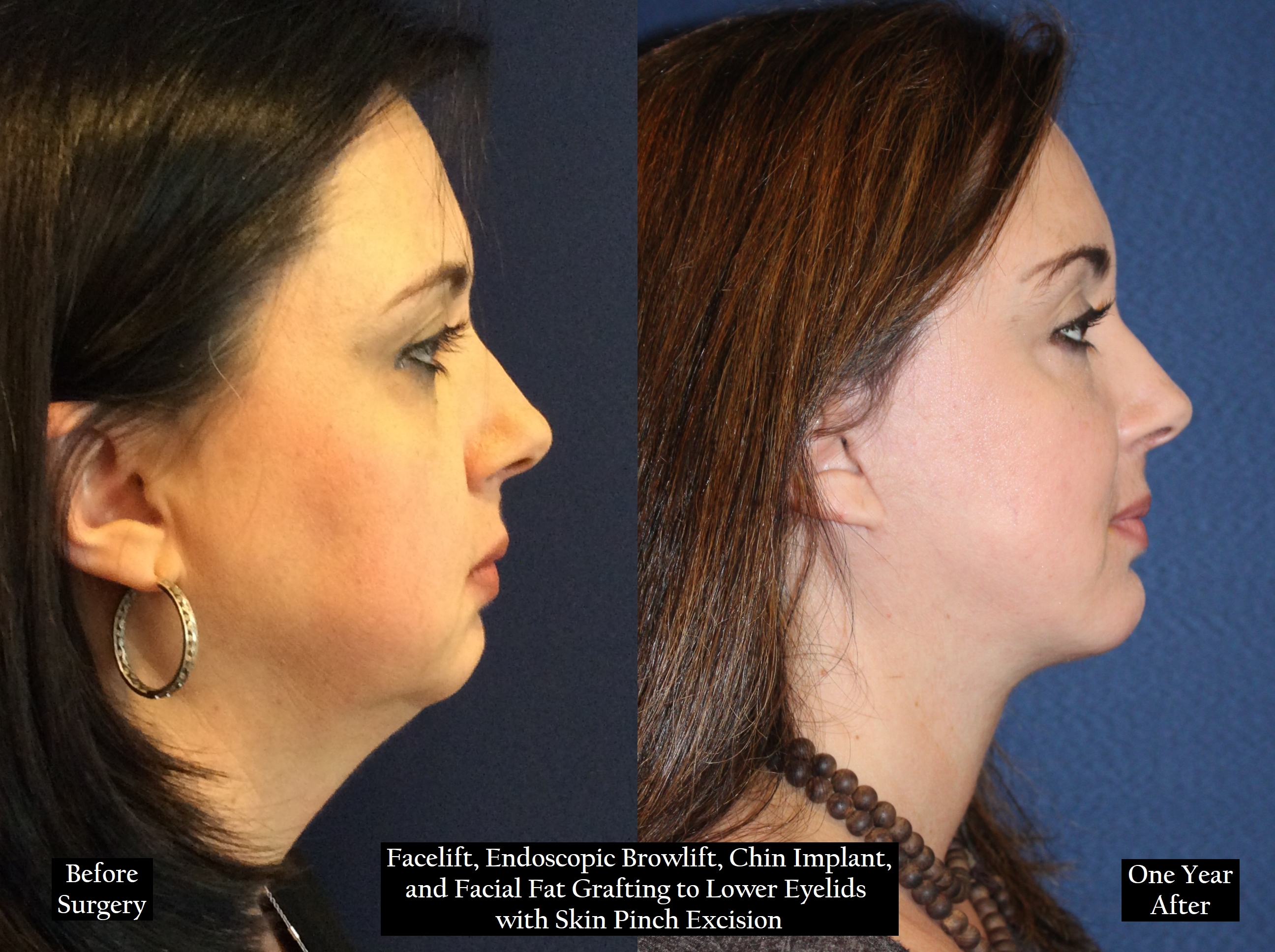 Before and after shot of a woman with brown hair from the right
