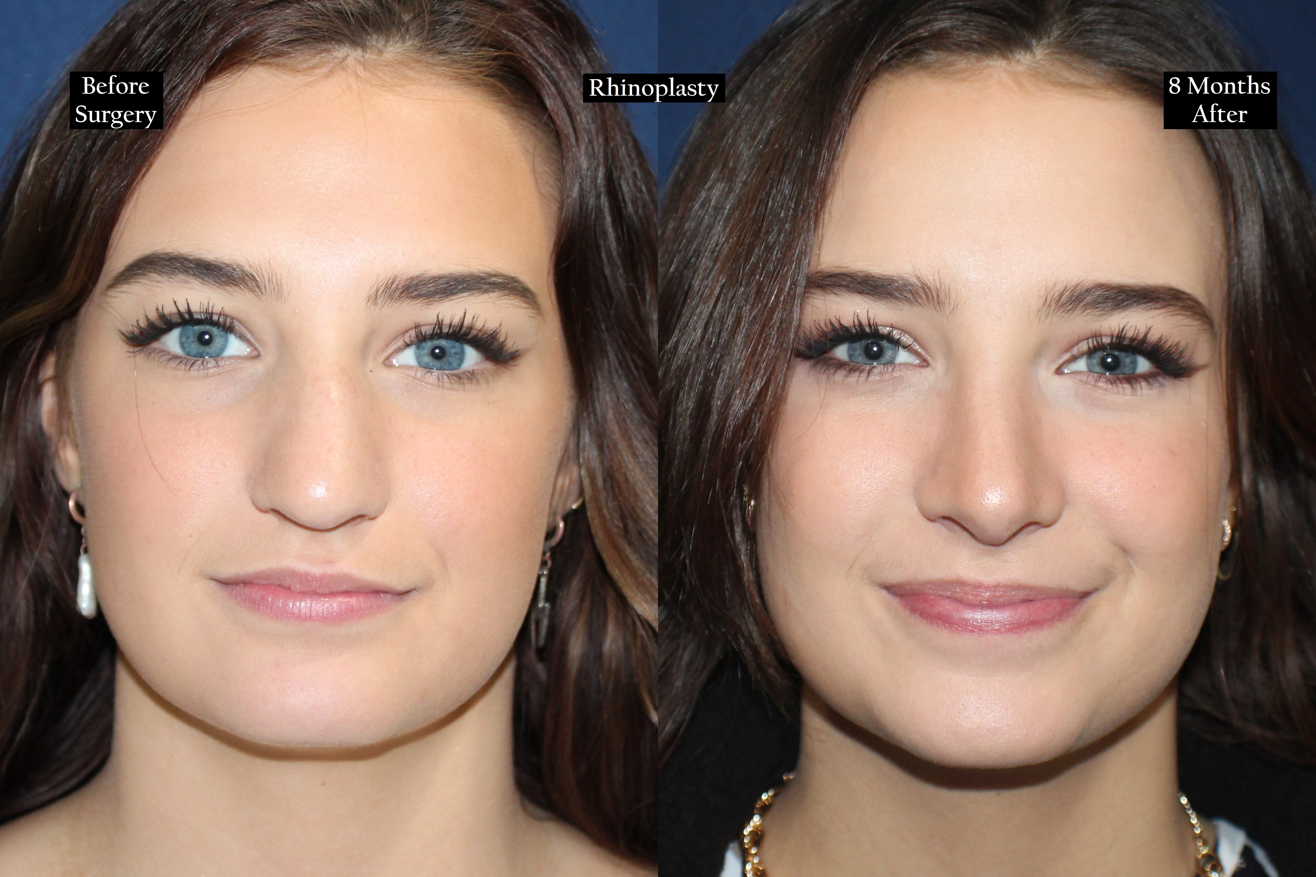 Before and after shot of woman with blue eyes head on