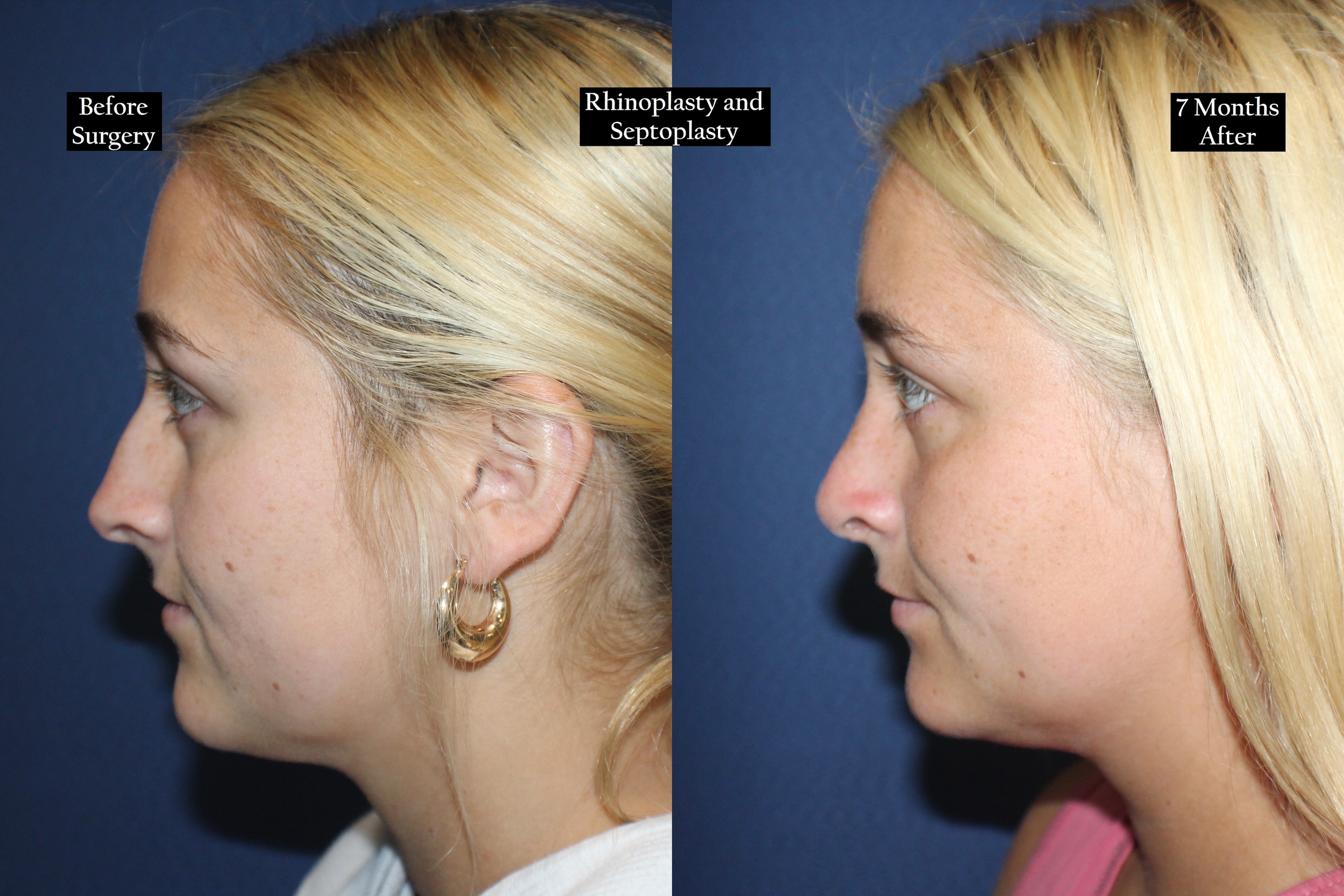 Before and after shot of woman's profile