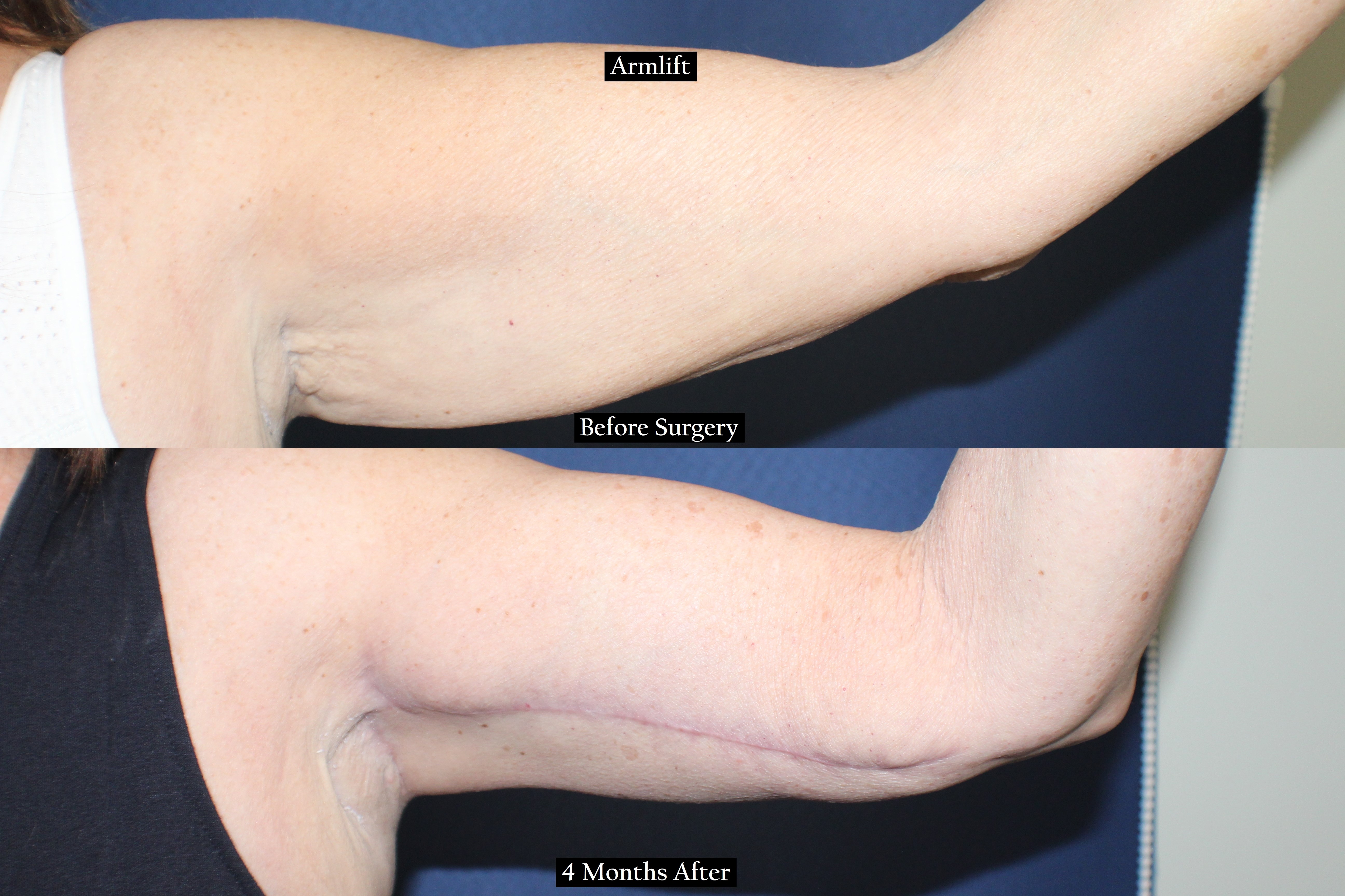 a before and after picture of an arm