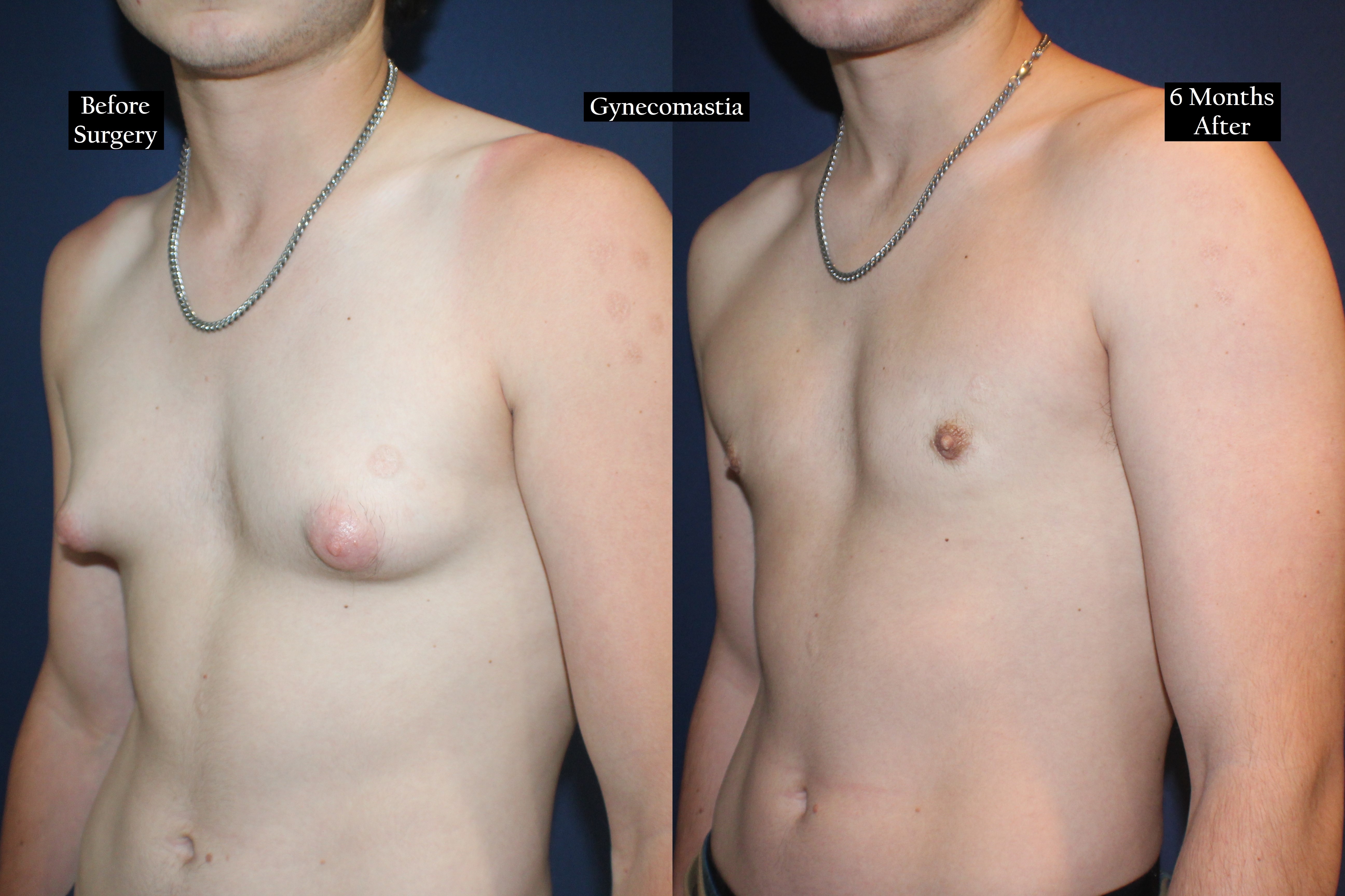 Before and after shot of a young man's torso