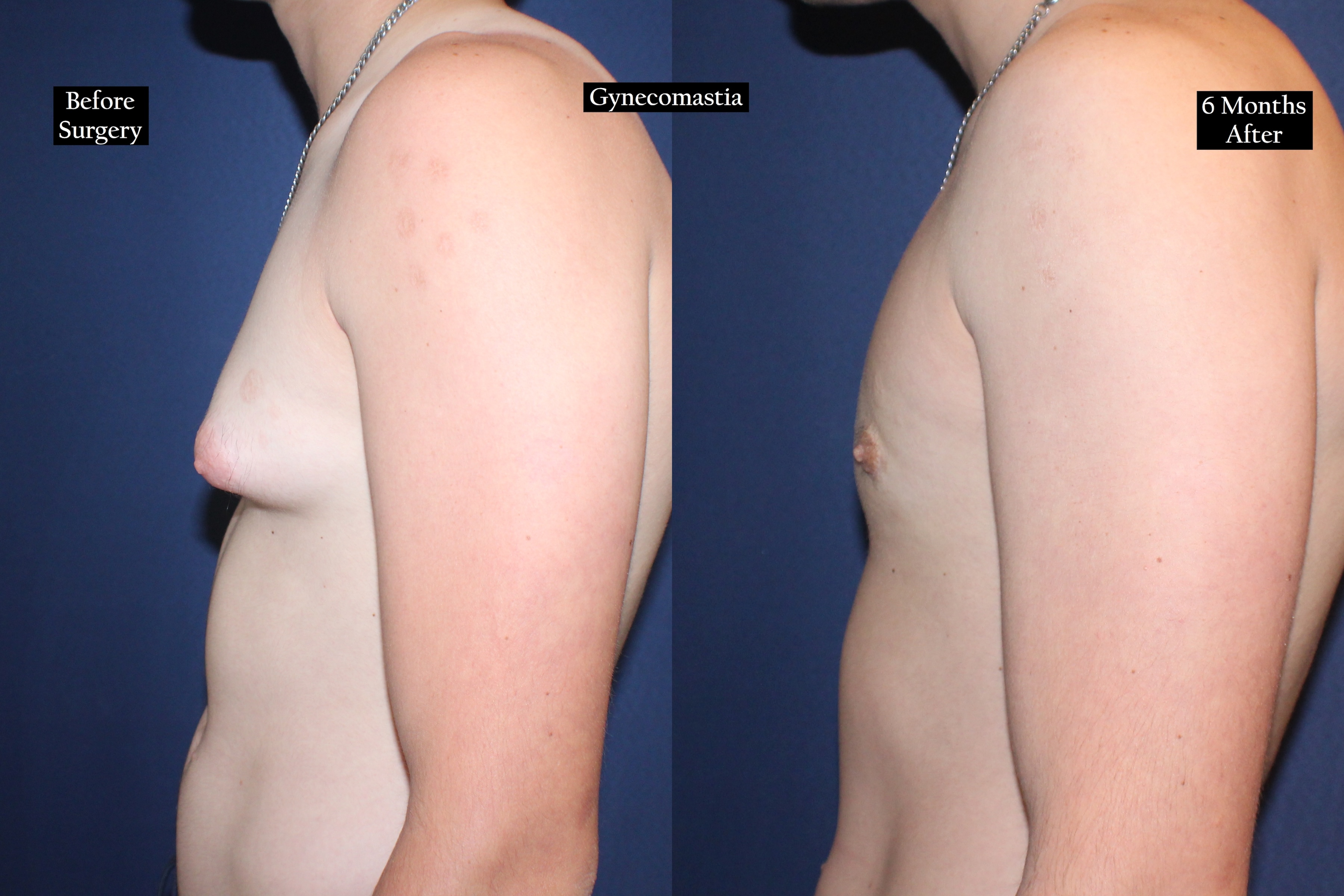 Before and after shot of a young man's torso