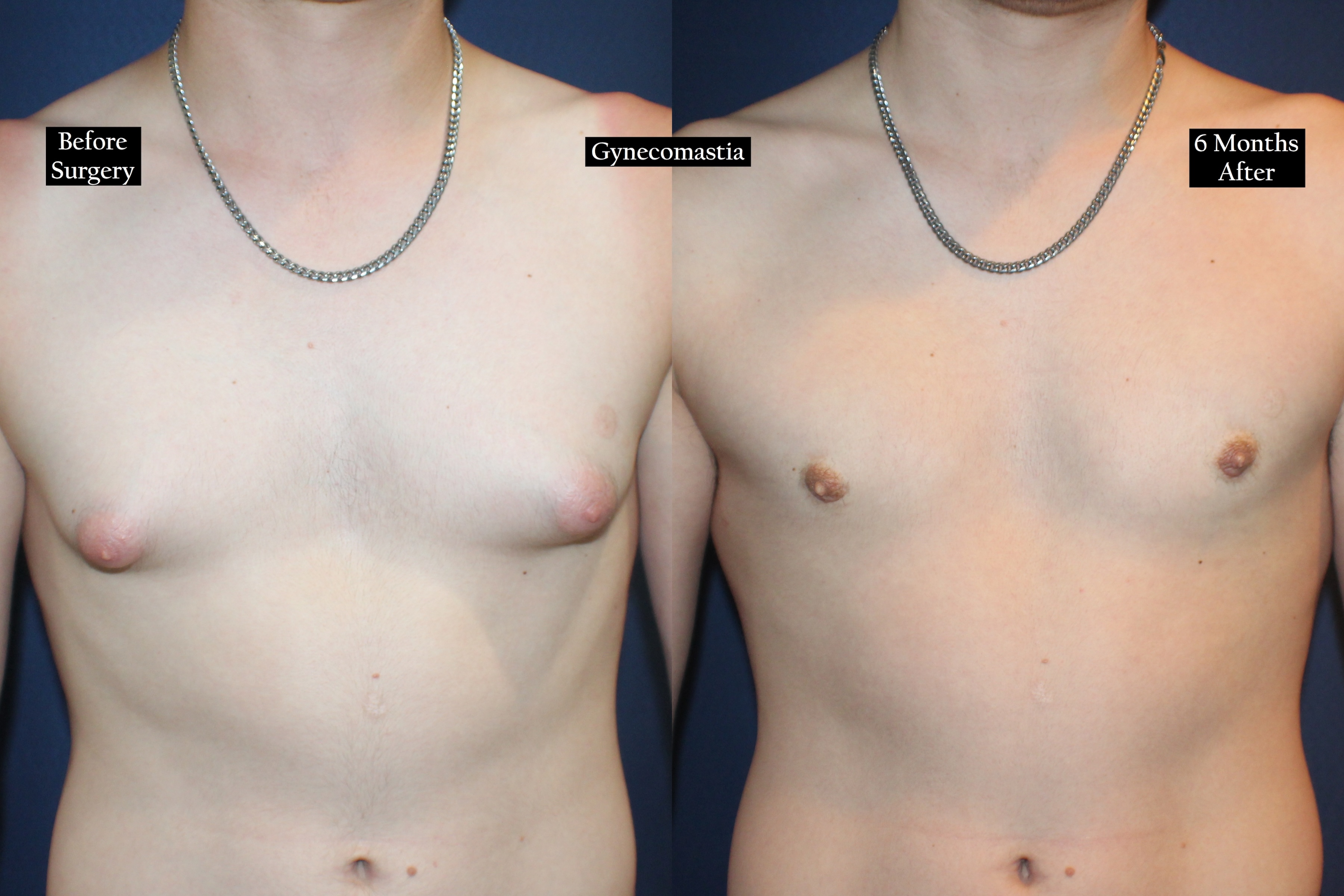 Before and after shot of a young man's torso wearing a necklace