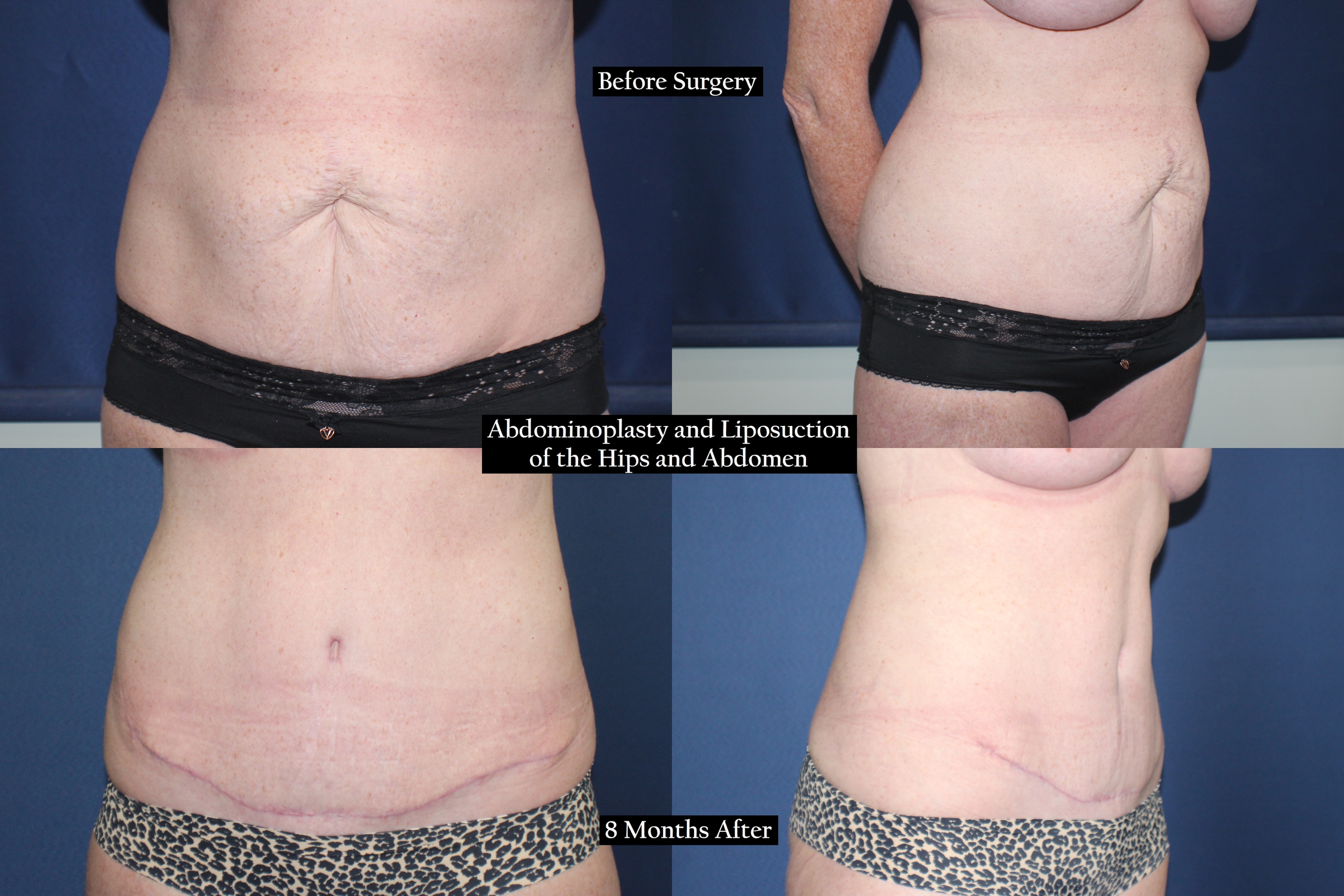 four pictures before and after from different angles of a woman's torso 