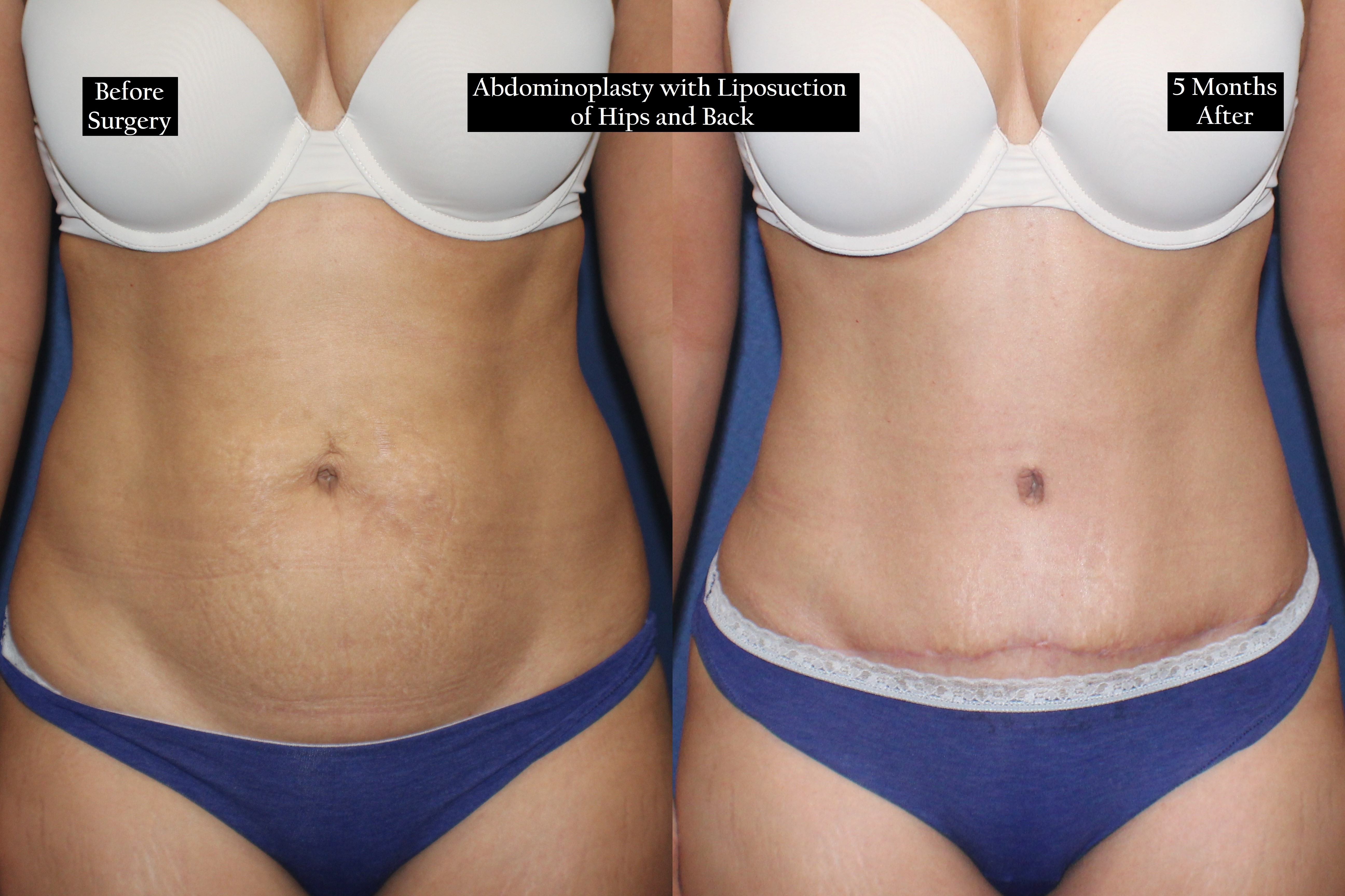 Before and after shot of a woman's torso
