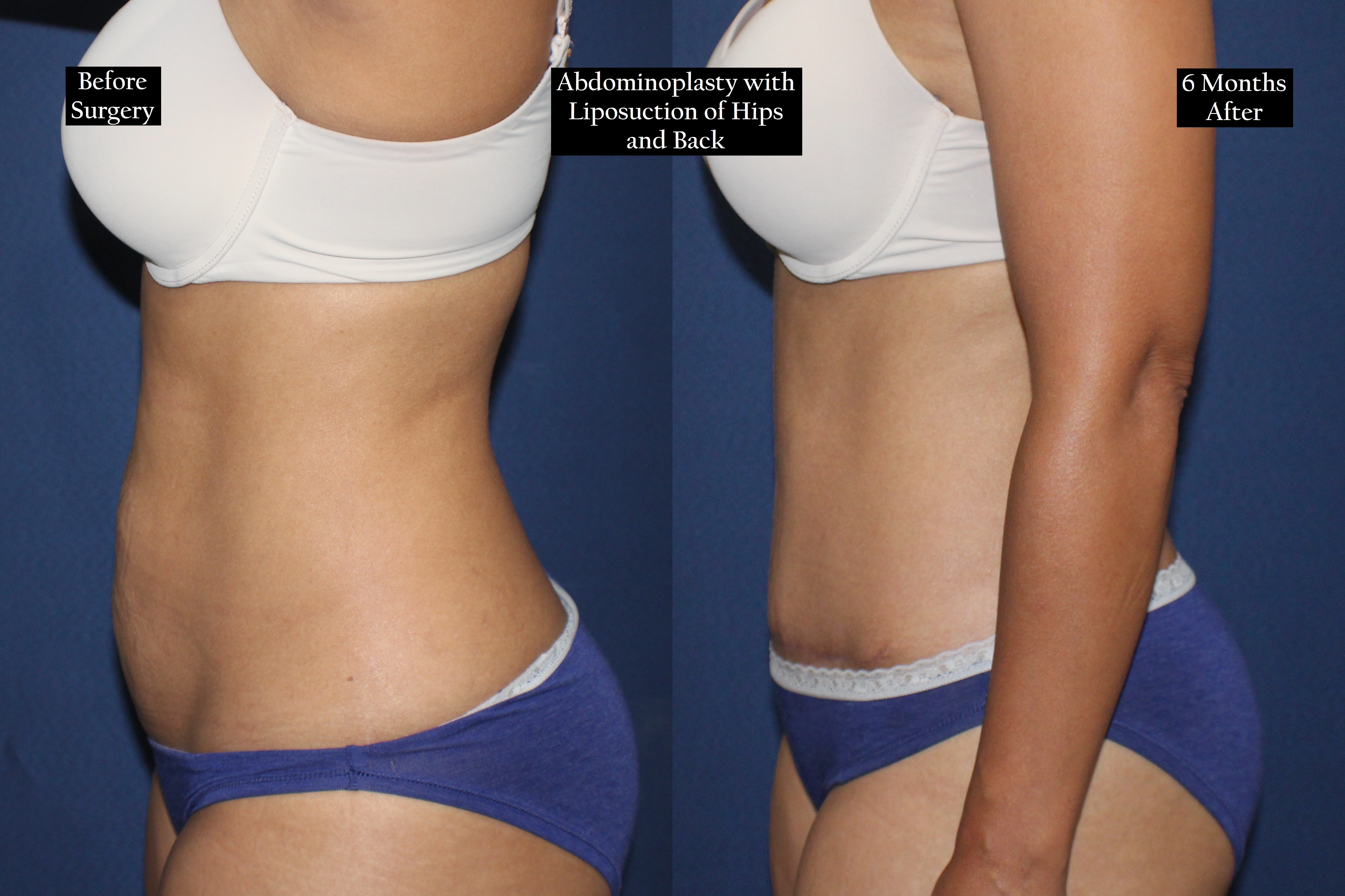 Before and after shot of a woman's torso in profile