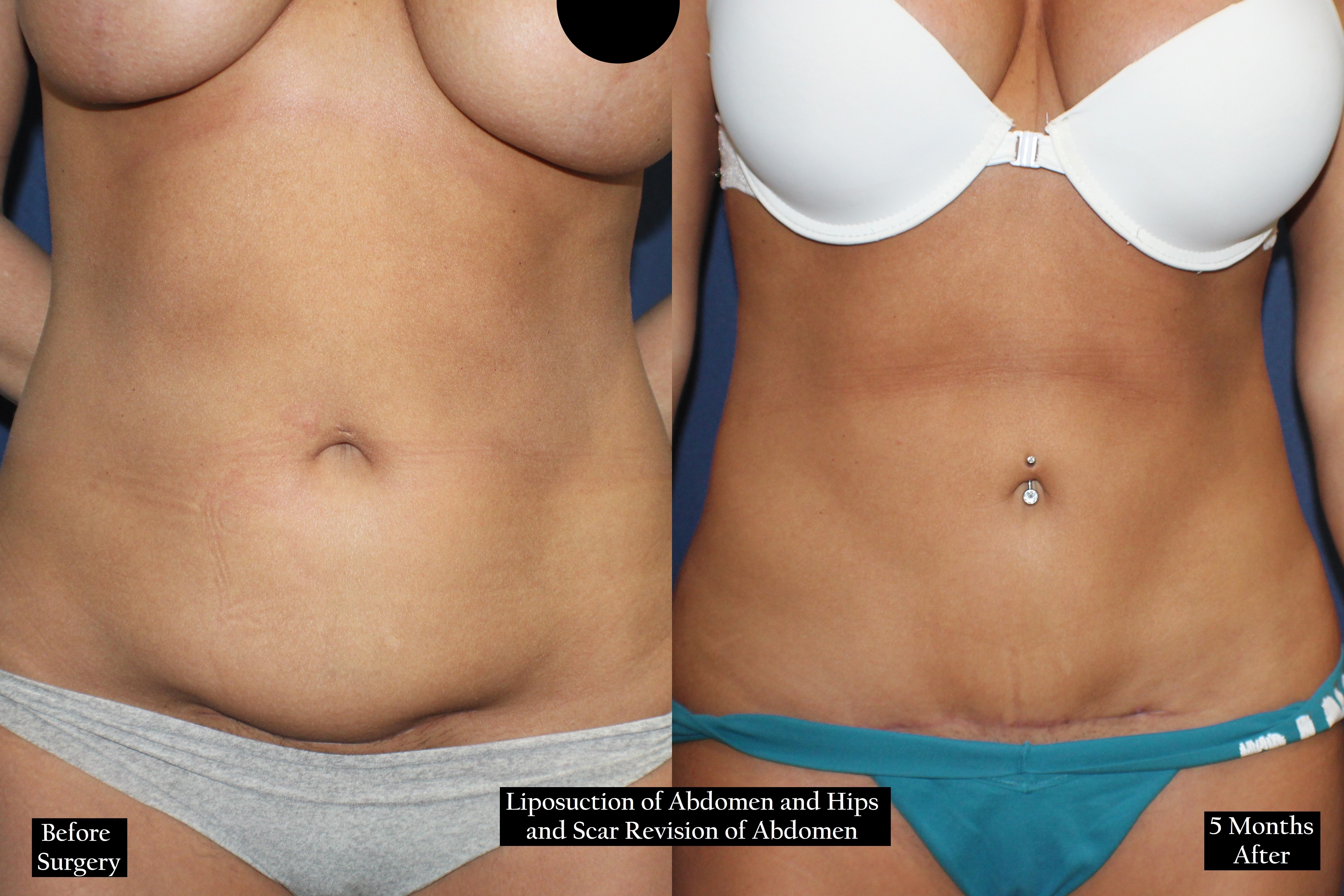 Before and after shot of a woman's torso from the front