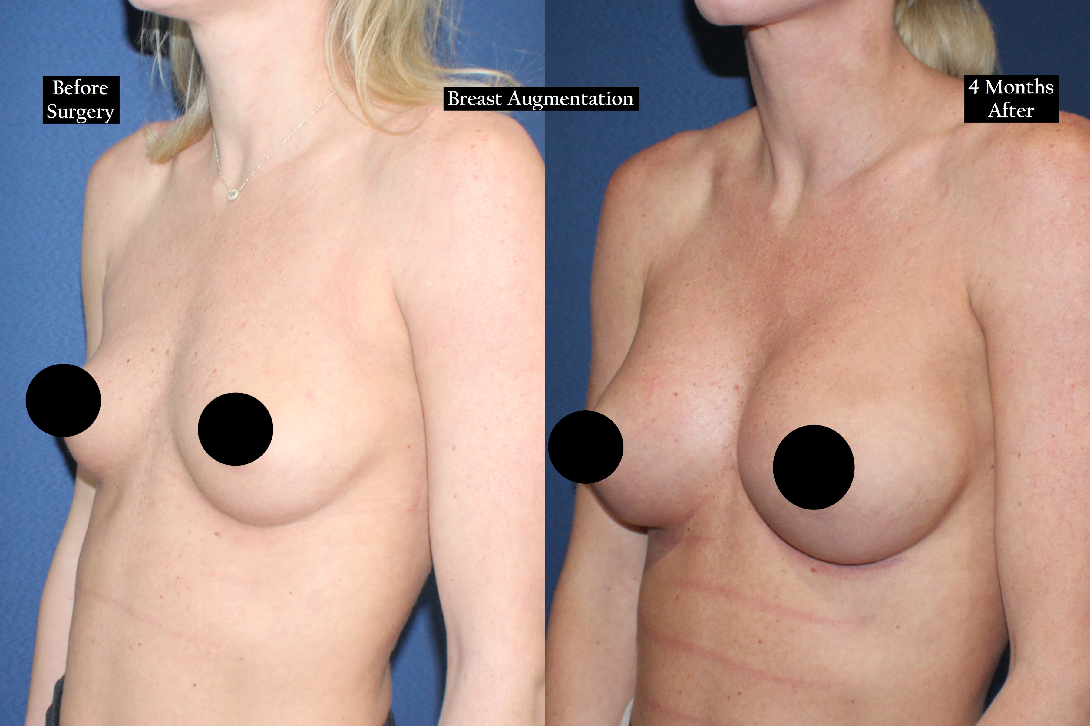 Before and after shot of a woman's chest