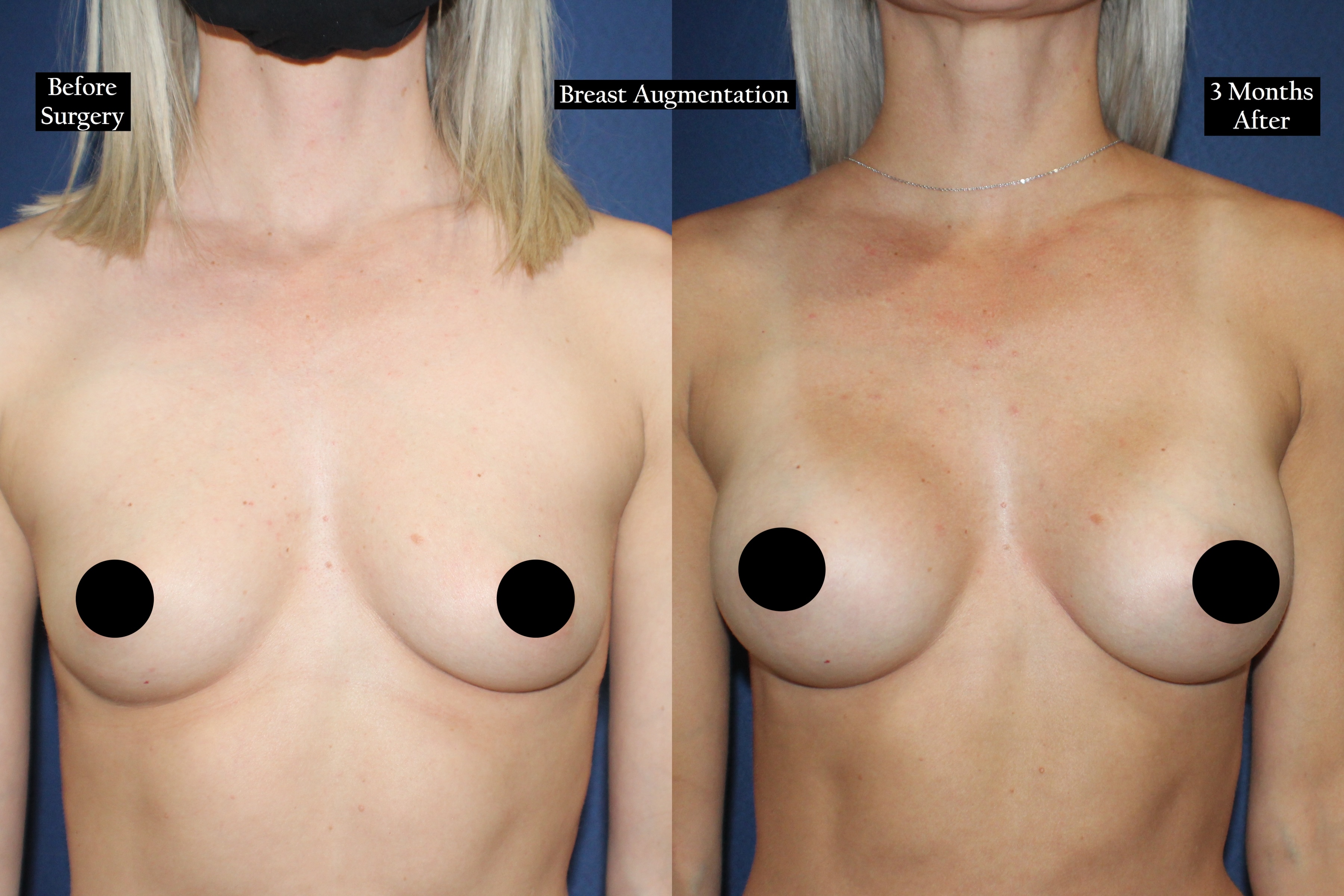 Before and after shot of a woman's chest