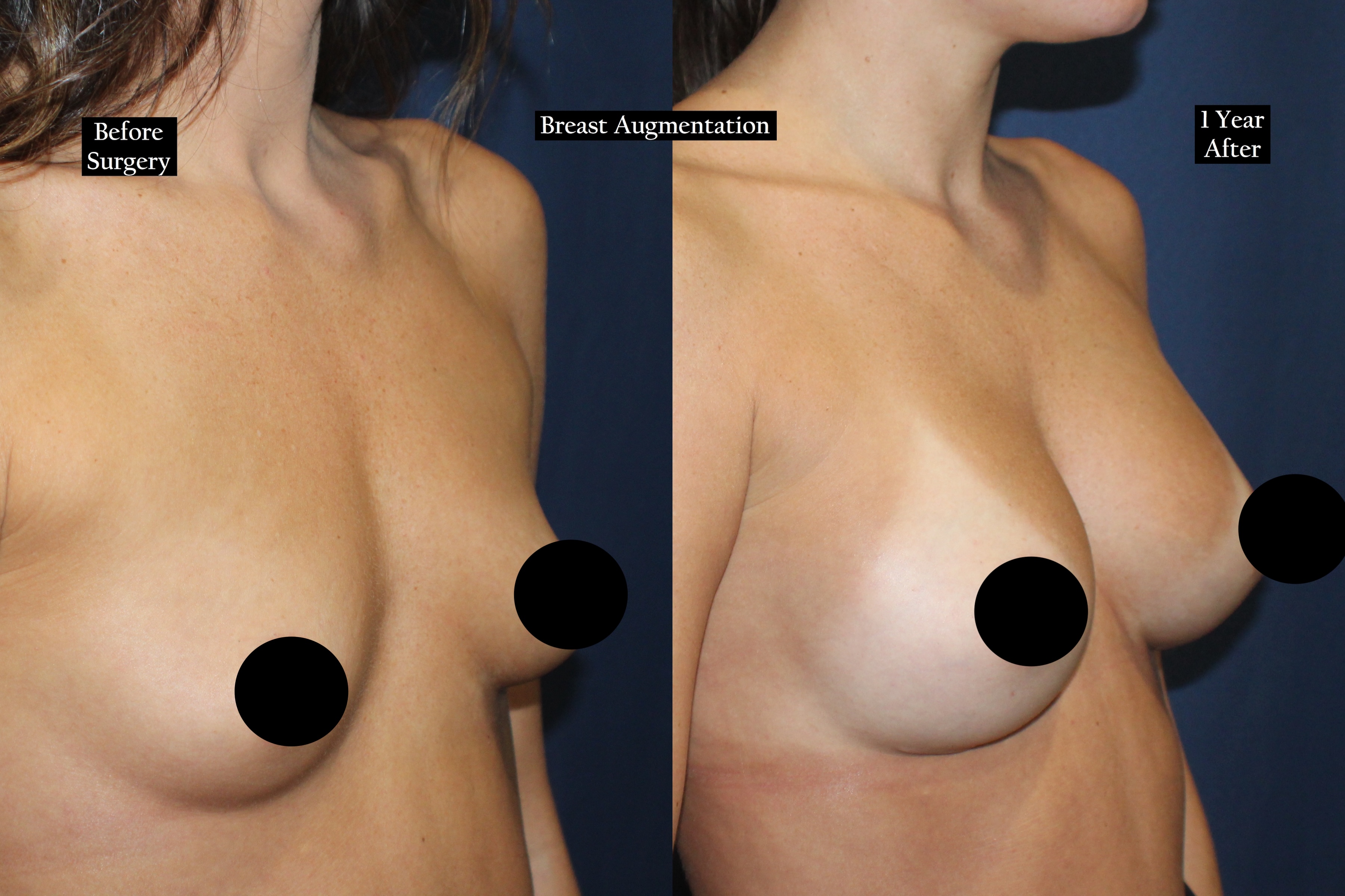 Before and after shot of a woman's chest