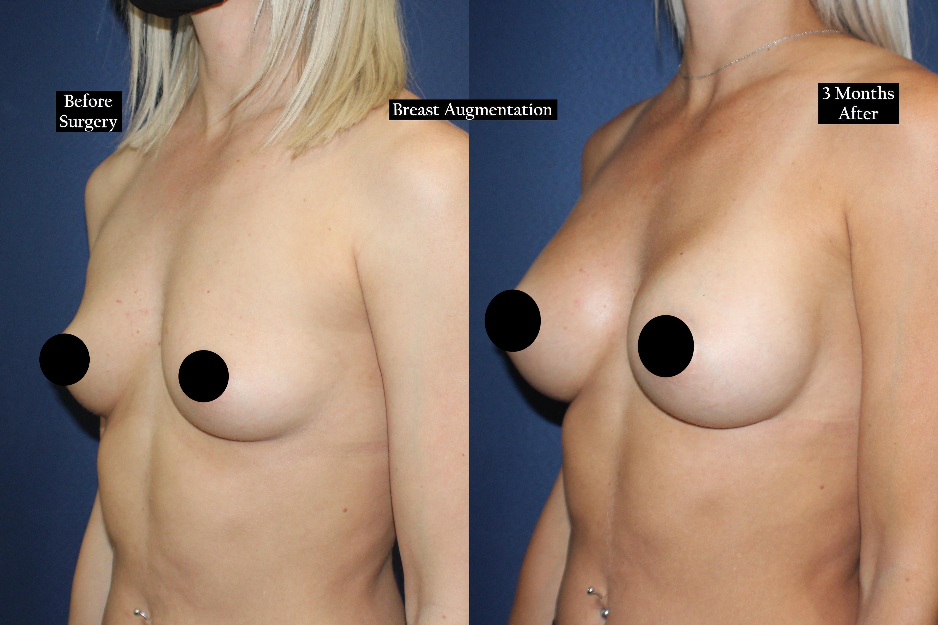 Before and after shot of a woman's chest