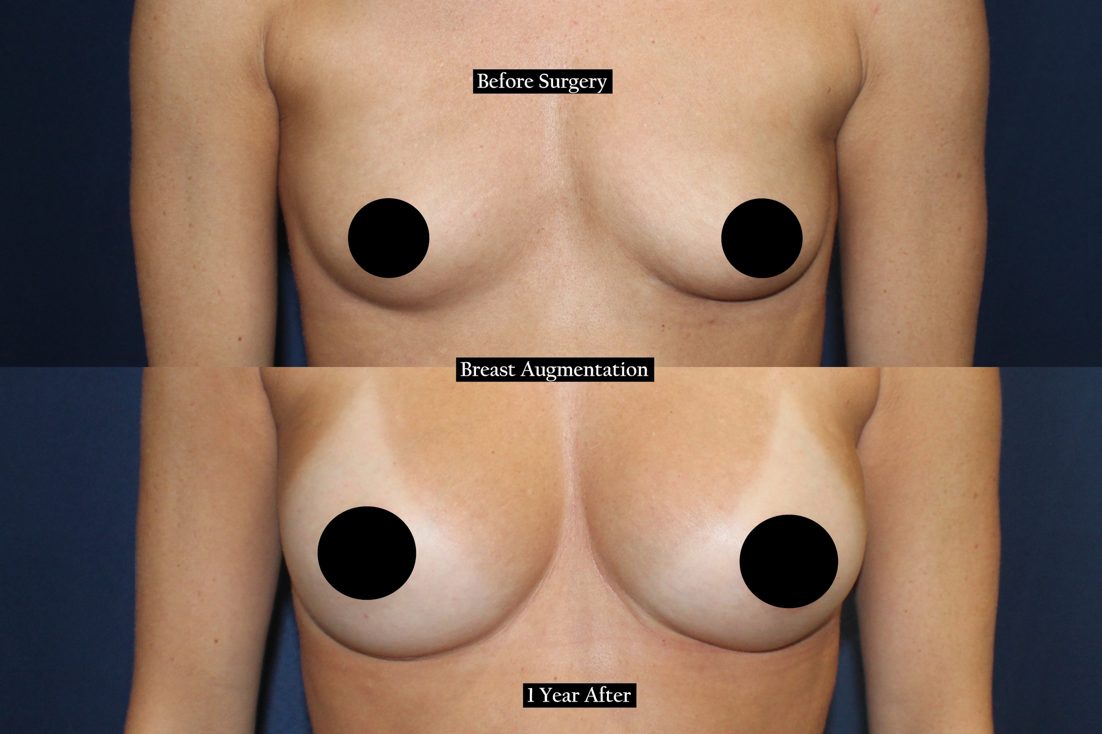 Before and after shot of a woman's chest