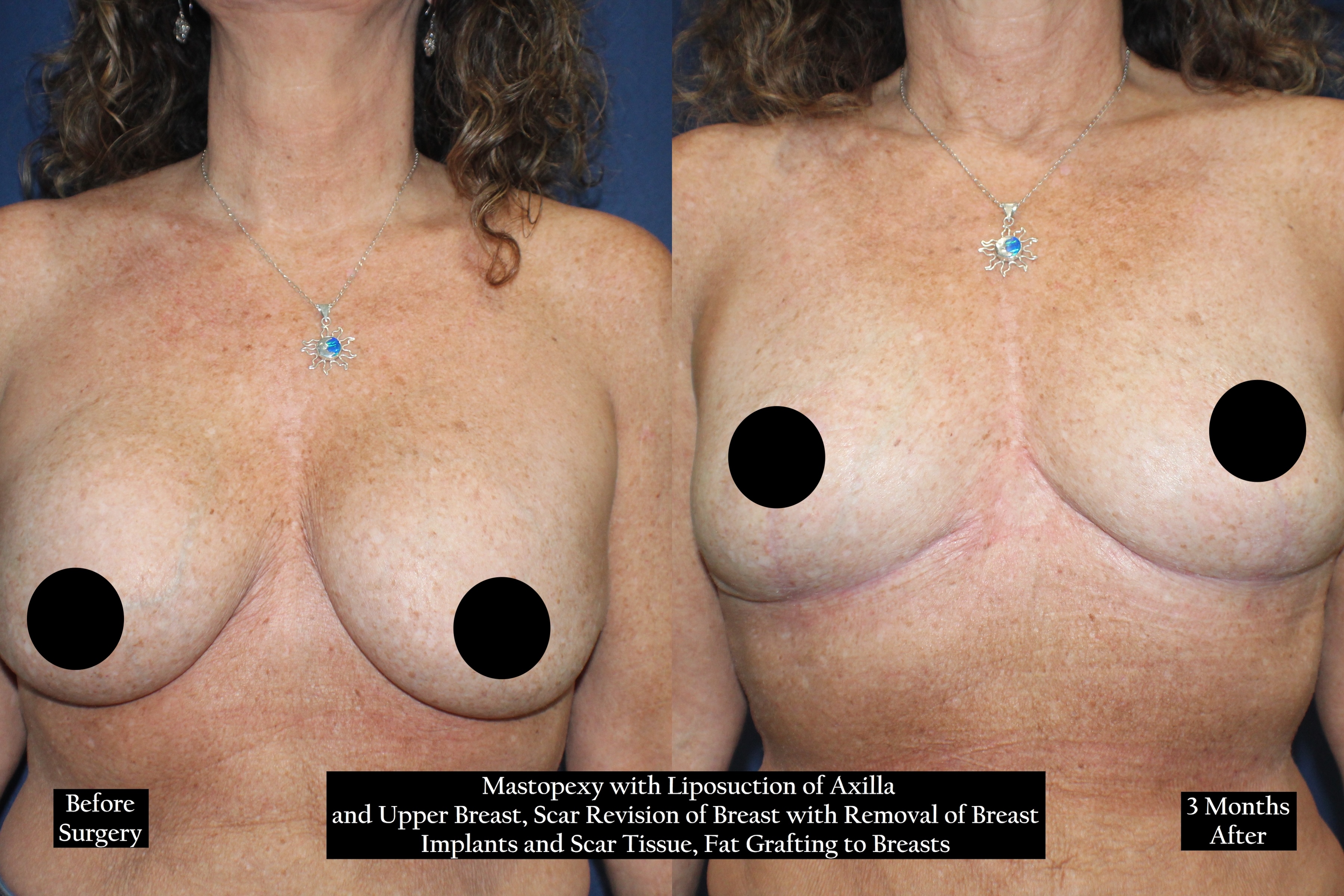 Before and after shot of a woman's chest