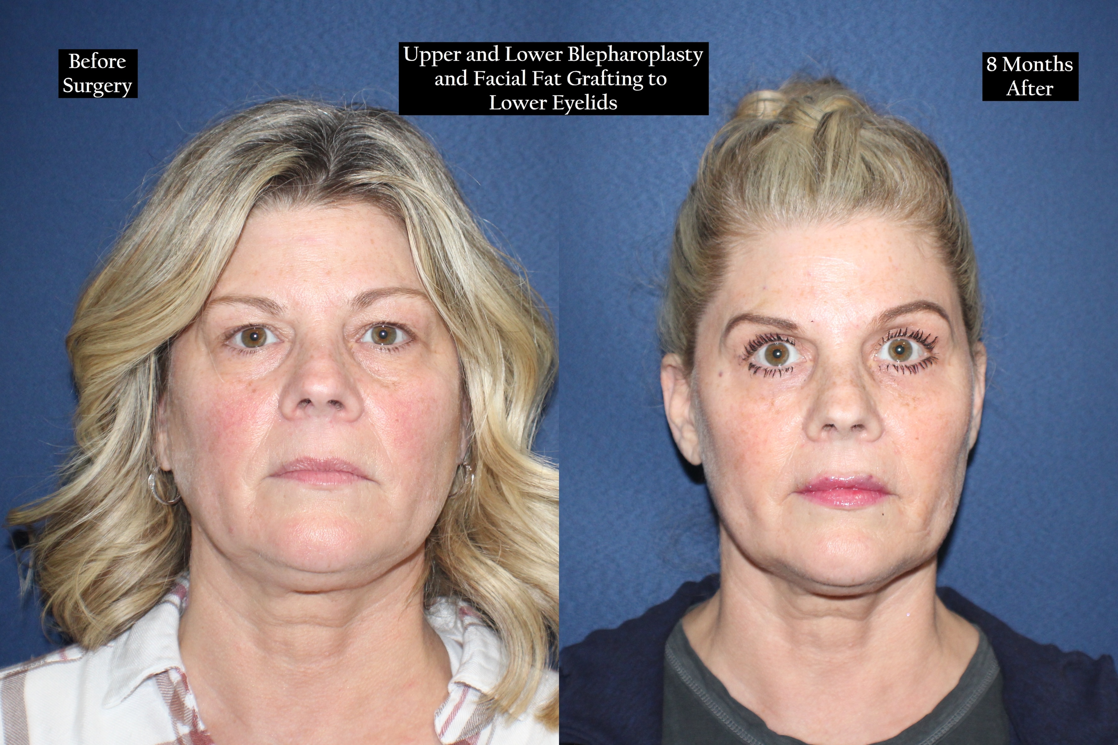 Before and after shot of woman's face