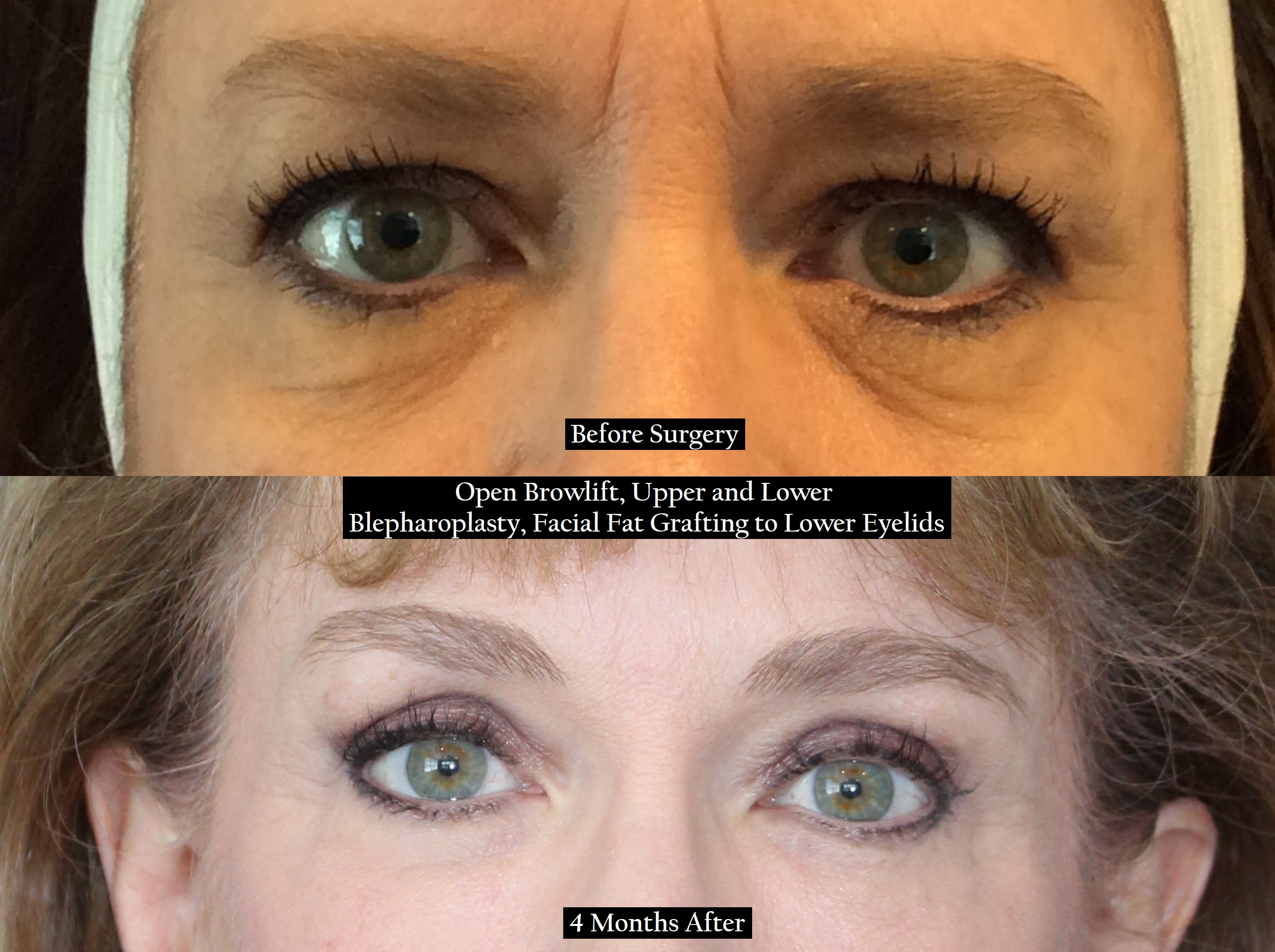 Before and after shot of eyes