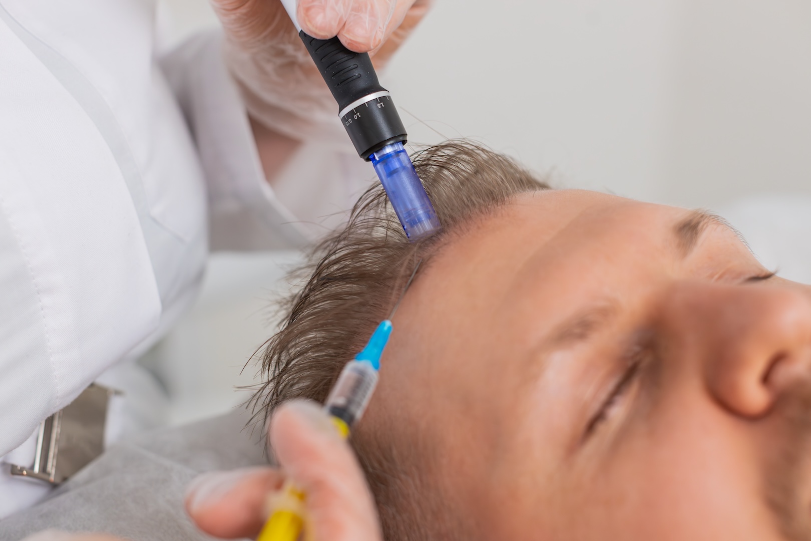 man getting injection in hairline