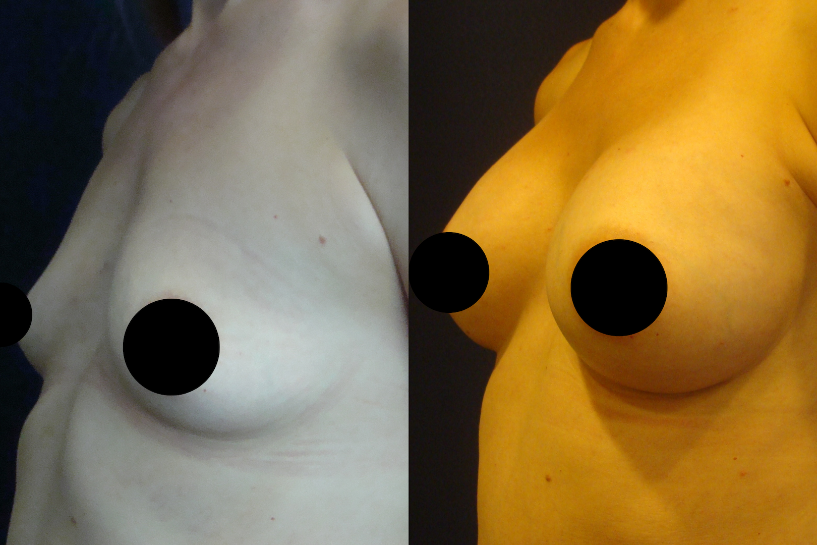 before and after images of a breast augmentation surgery with black and white text boxes