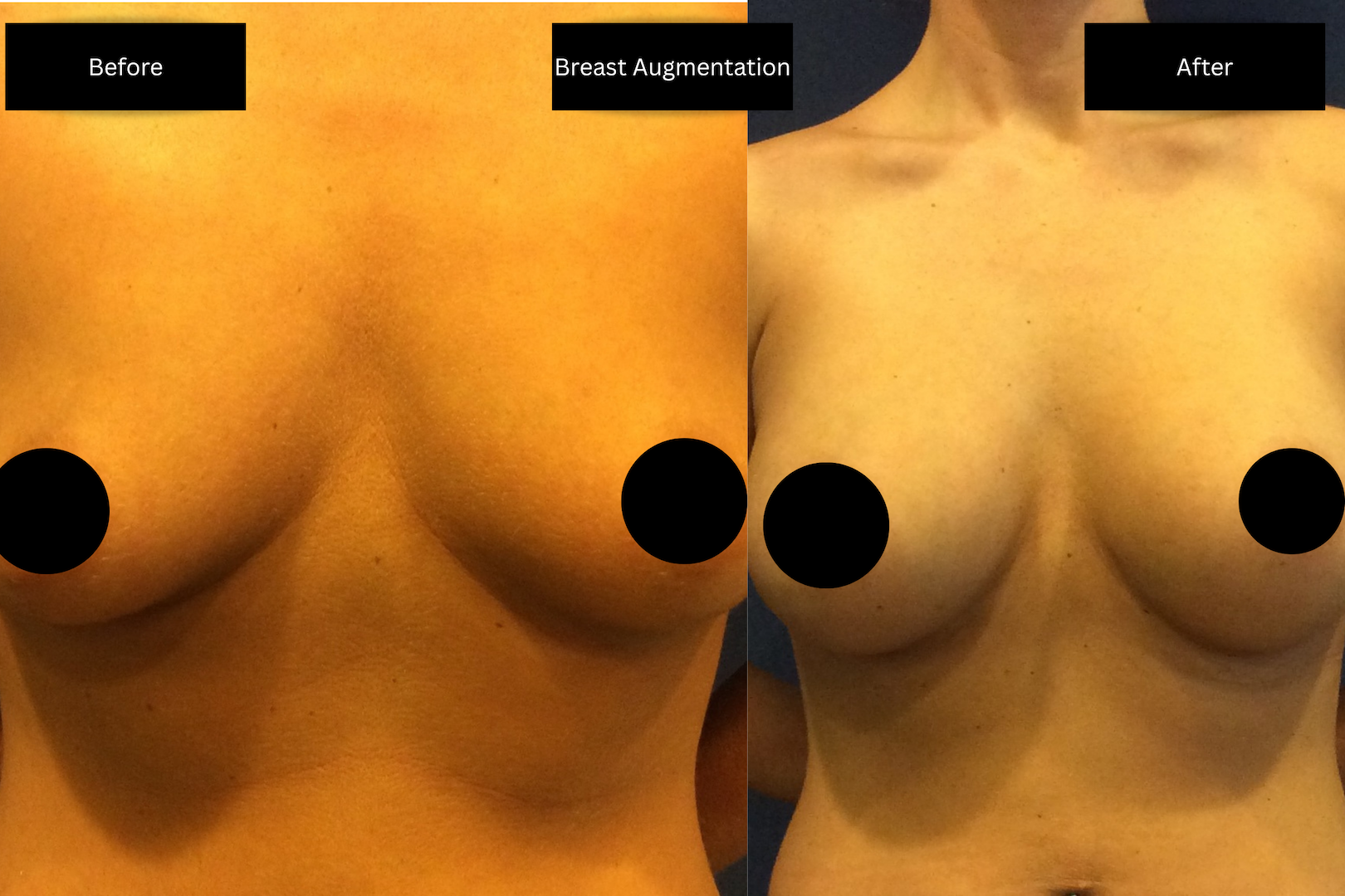 before and after images of a breast augmentation surgery with black and white text boxes