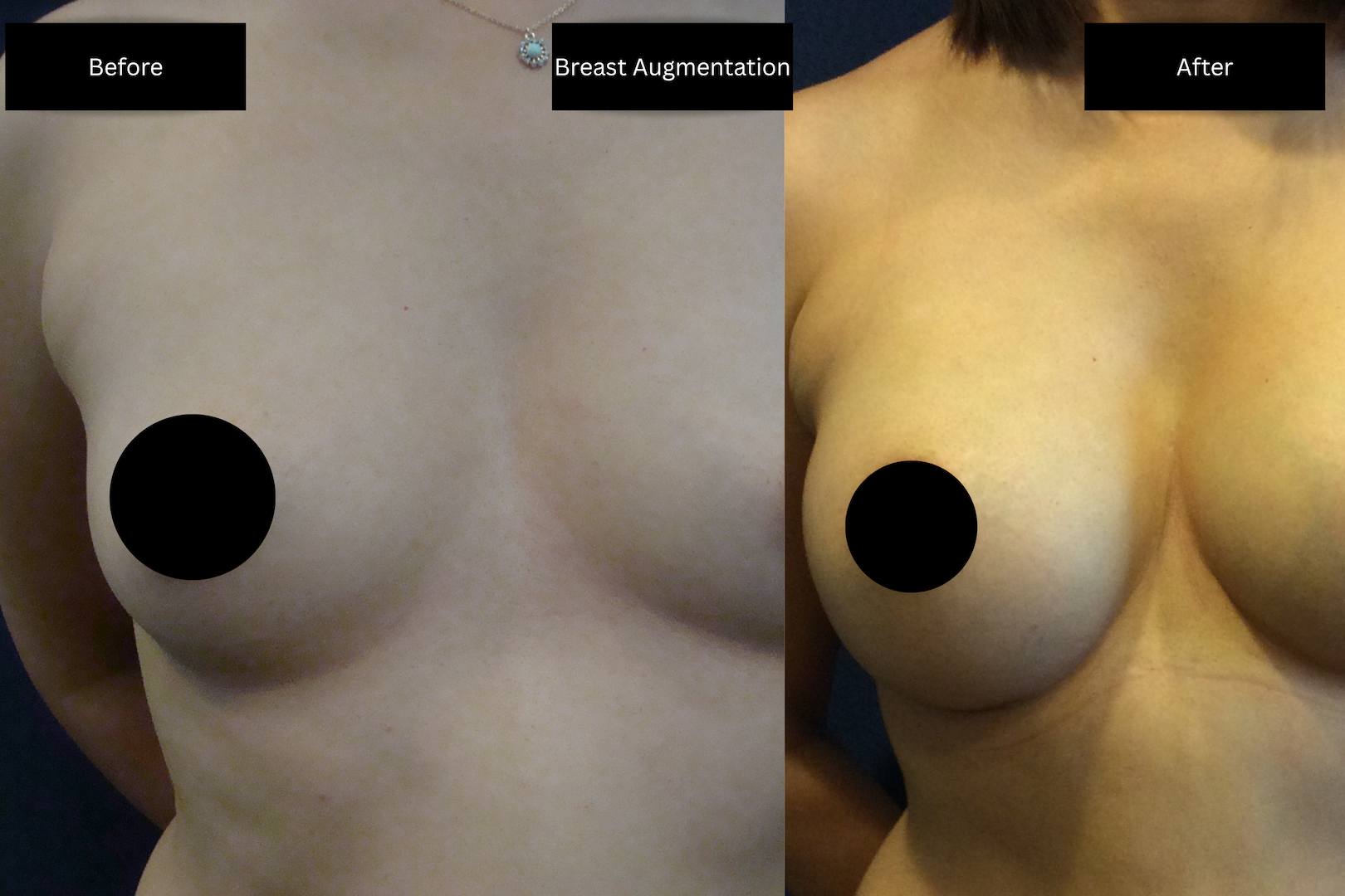before and after images of a breast augmentation surgery with black and white text boxes