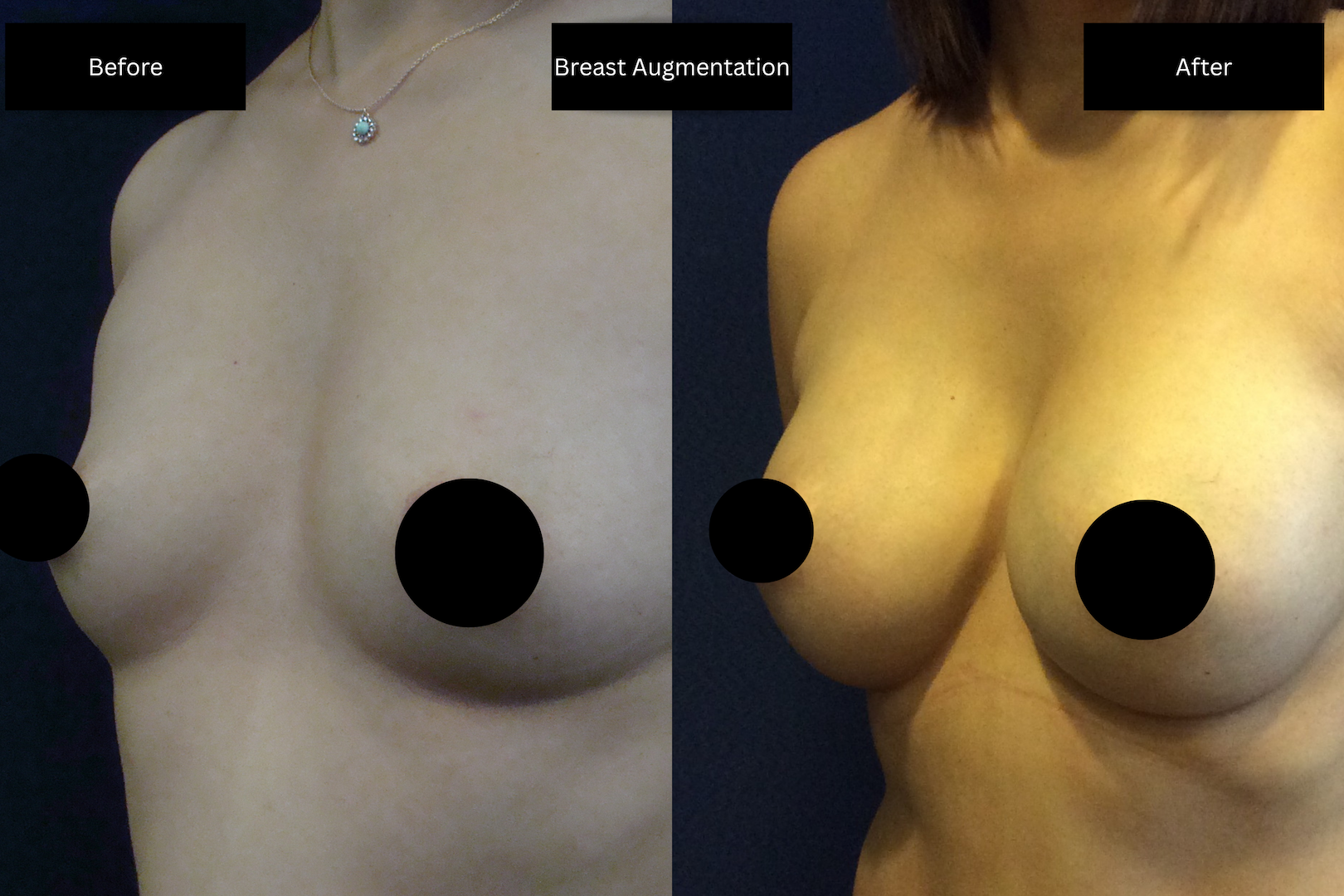 before and after images of a breast augmentation surgery with black and white text boxes