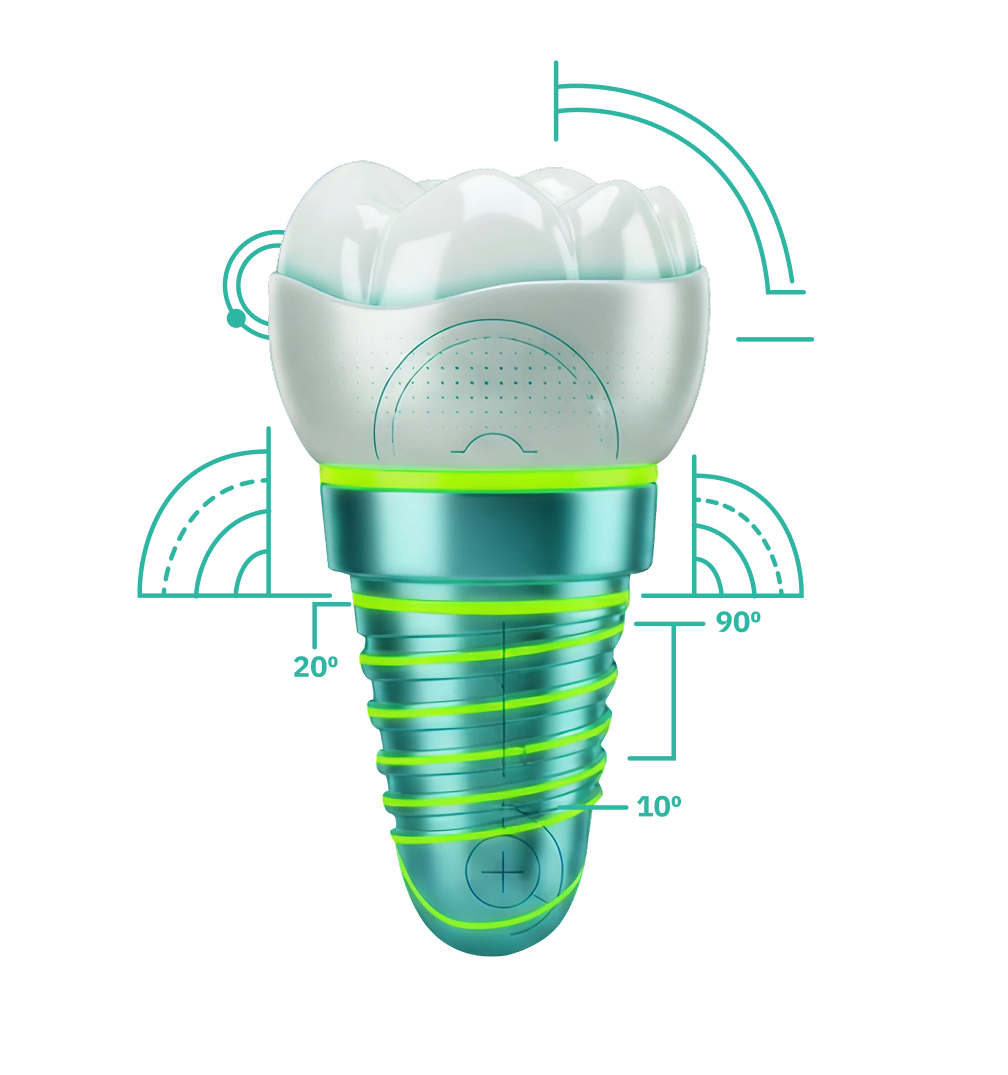 Digital render of a dental implant with a white tooth crown on top and metallic screw base with green highlights.