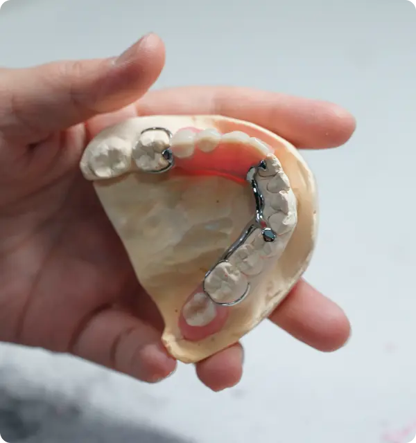 Hand holding a dental partial denture model with metal clasps and artificial teeth.