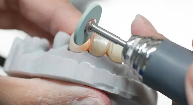 Close-up of hands polishing dental prosthetic teeth on a mold with a rotary tool.