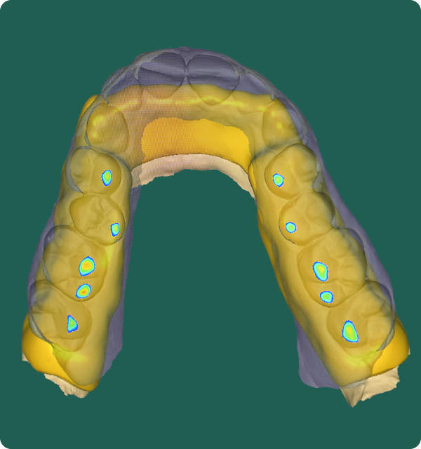 3D dental arch model with highlighted areas on teeth in blue and yellow on a green background.