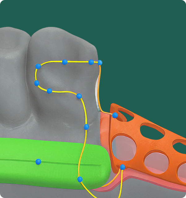 3D model of a tooth with connected blue points and an orange scaffold-like structure on the side.