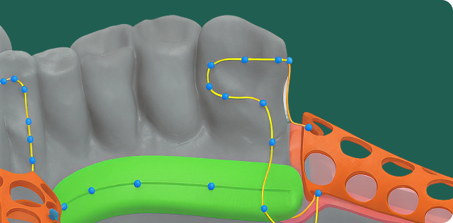 3D dental model showing partial denture framework with teeth and metal clasps.
