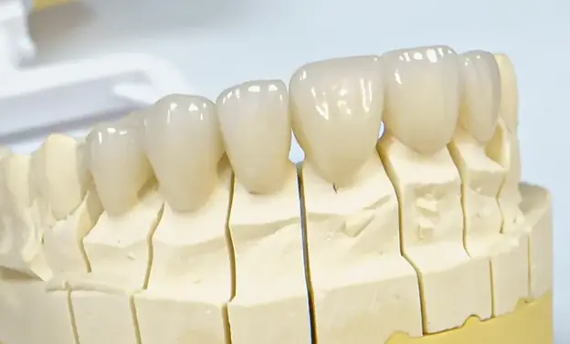 Close-up of dental model with several artificial teeth mounted on a beige cast base.