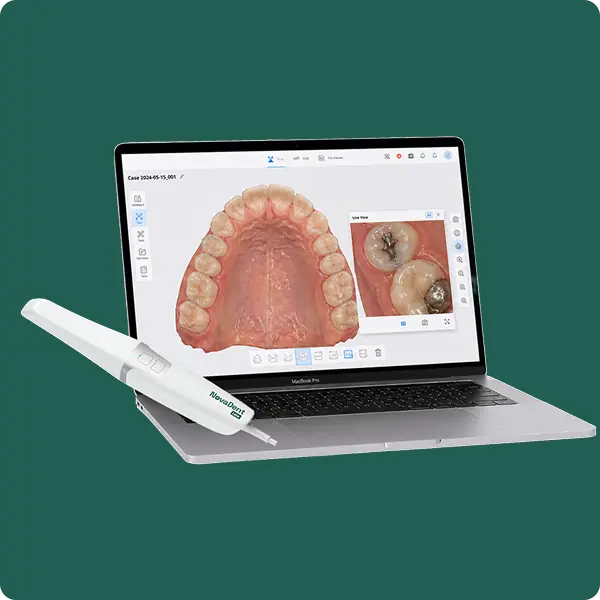 Dental scanner device next to a laptop showing a 3D digital model of teeth and a close-up tooth image.