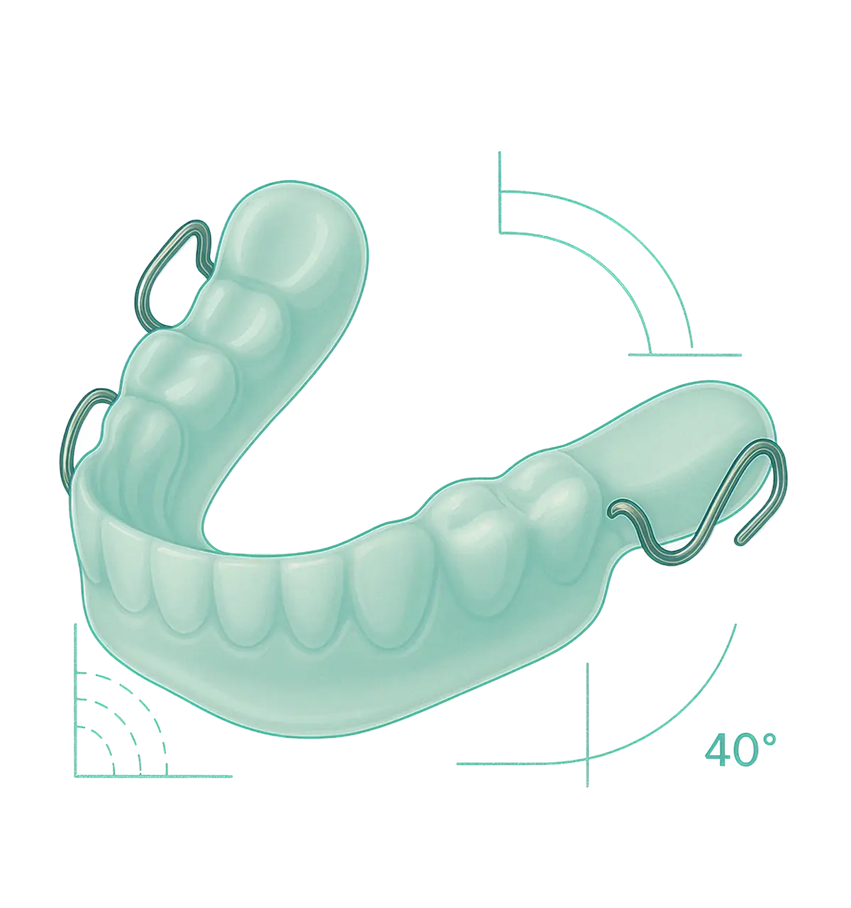 Illustration of a removable partial denture with clasps and angle measurement diagrams.